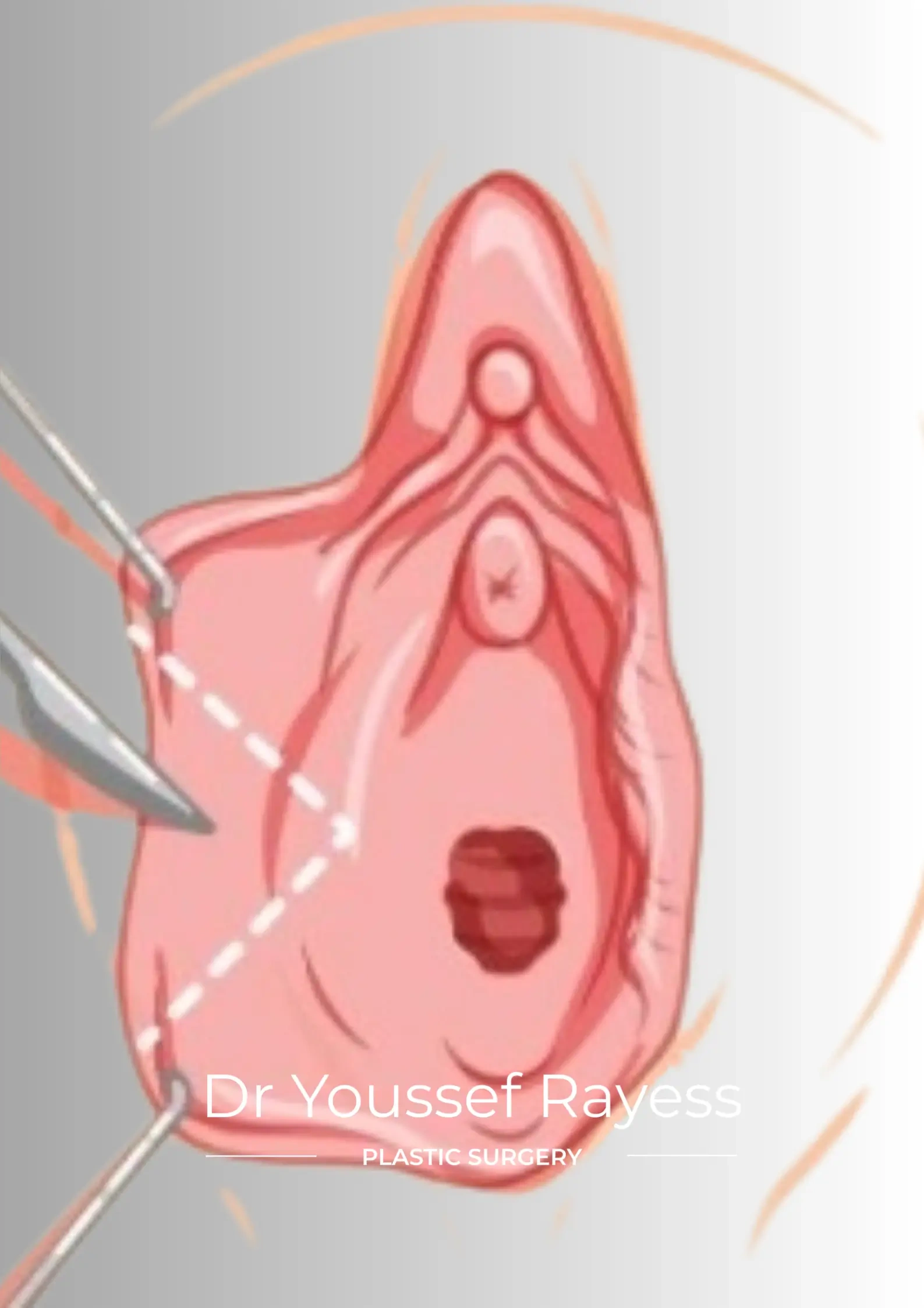 Front view before labia reduction surgery result by Dr Youssef Rayess in Beirut showing natural intimate area rejuvenation and harmony