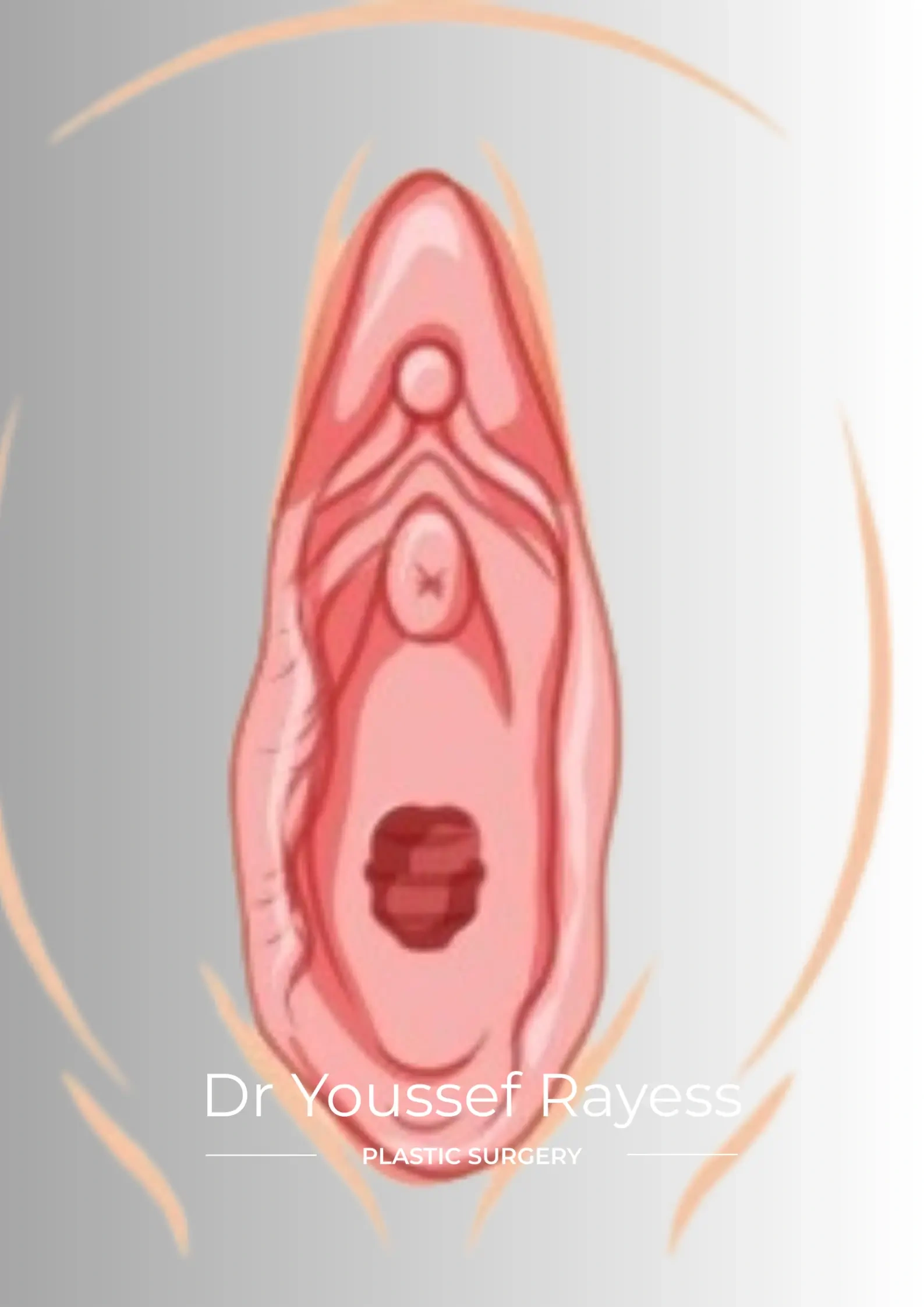 Front view after labia reduction surgery result by Dr Youssef Rayess in Beirut showing natural intimate area rejuvenation and harmony