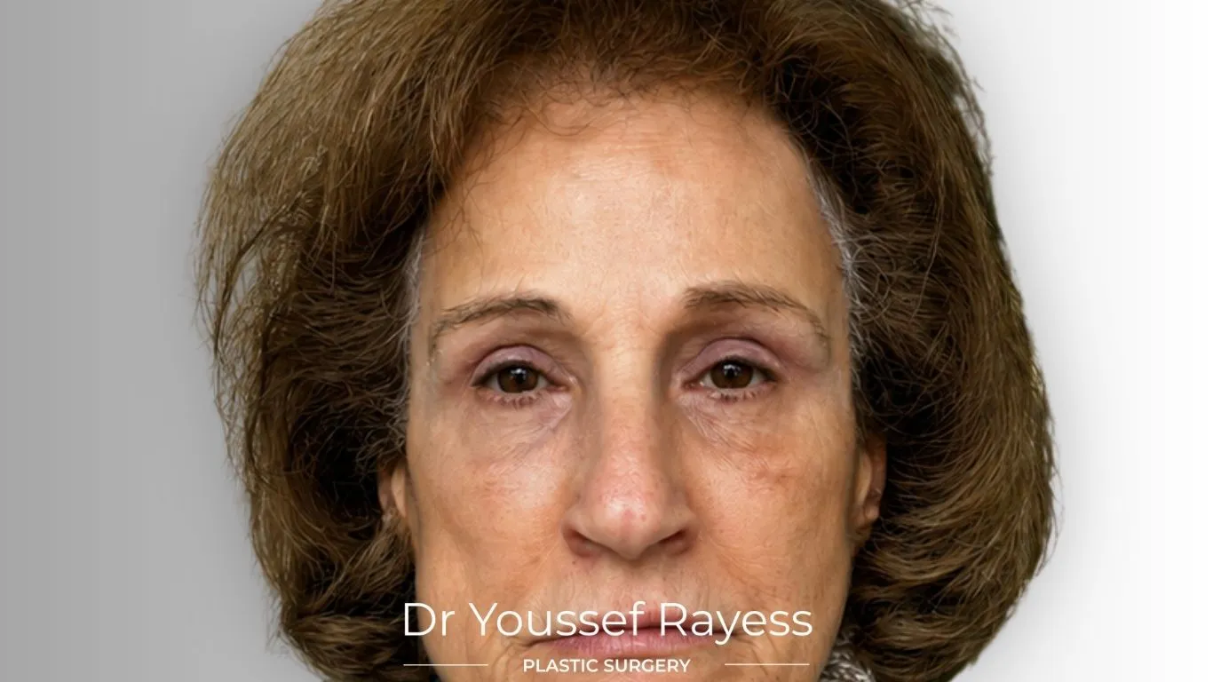 Front view after eyelid surgery result by Dr Youssef Rayess in Beirut and Dubai showing natural eyelid rejuvenation and facial harmony