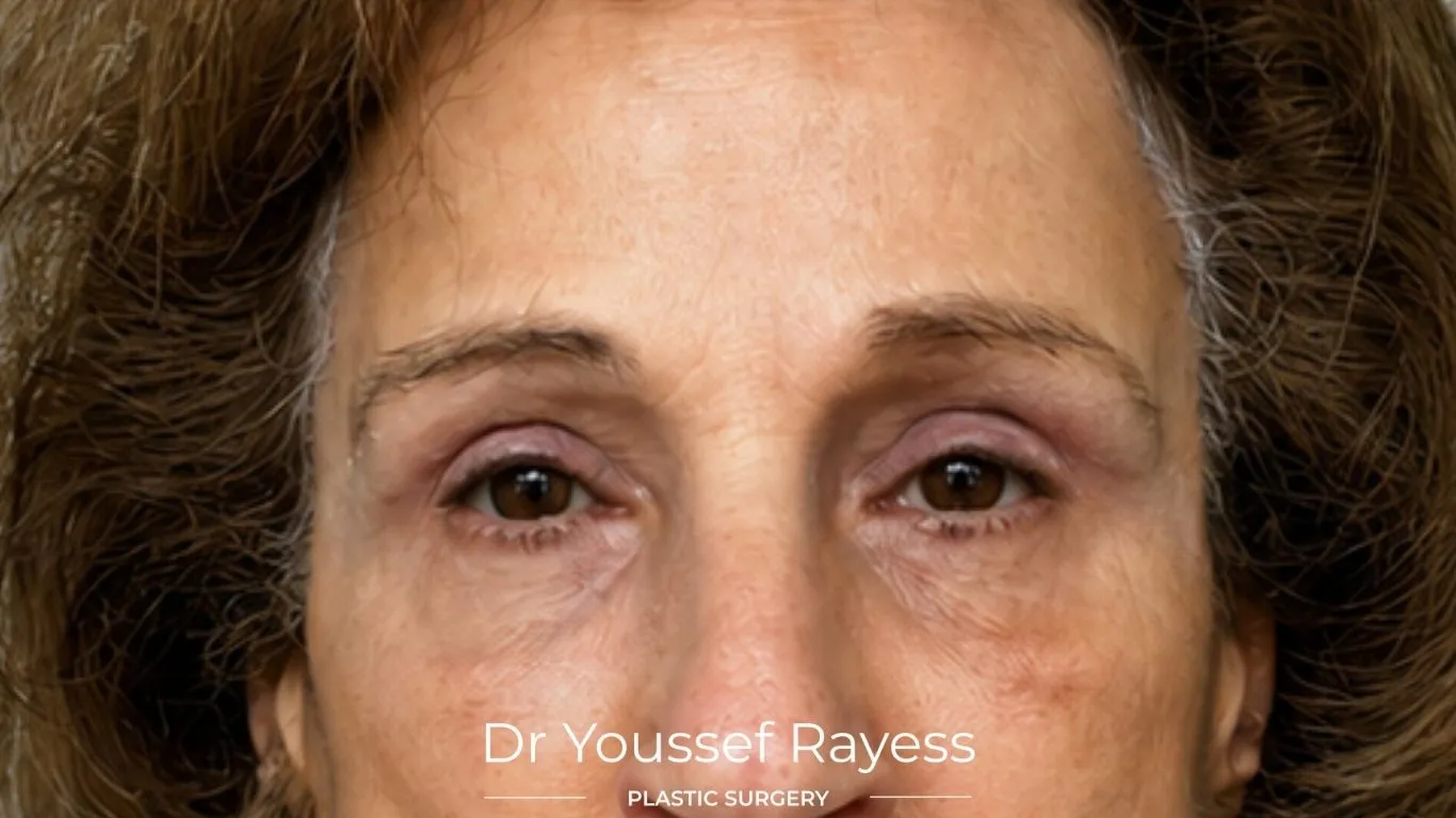 Close-up front view after eyelid surgery result by Dr Youssef Rayess in Beirut and Dubai showing natural eyelid rejuvenation and facial harmony