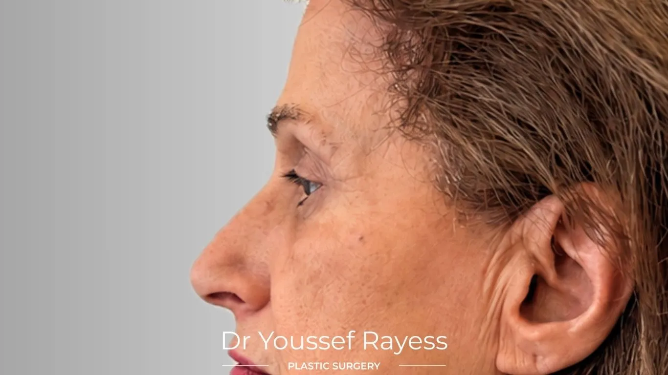 Side view after eyelid surgery result by Dr Youssef Rayess in Beirut and Dubai showing natural eyelid rejuvenation and facial harmony