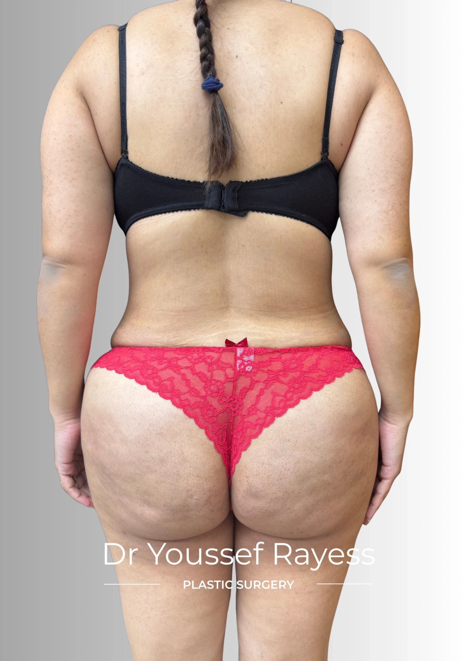 Back view after body lift and Brazilian butt lift surgery result by Dr Youssef Rayess in Beirut showing natural body rejuvenation and harmony