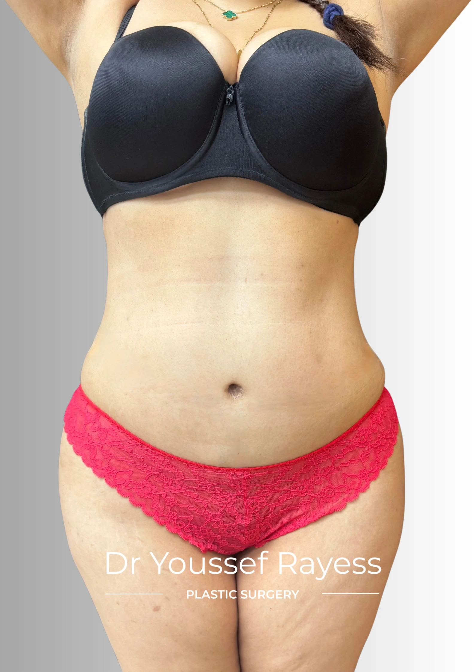 Front view after body lift and Brazilian butt lift surgery result by Dr Youssef Rayess in Beirut showing natural body rejuvenation and harmony