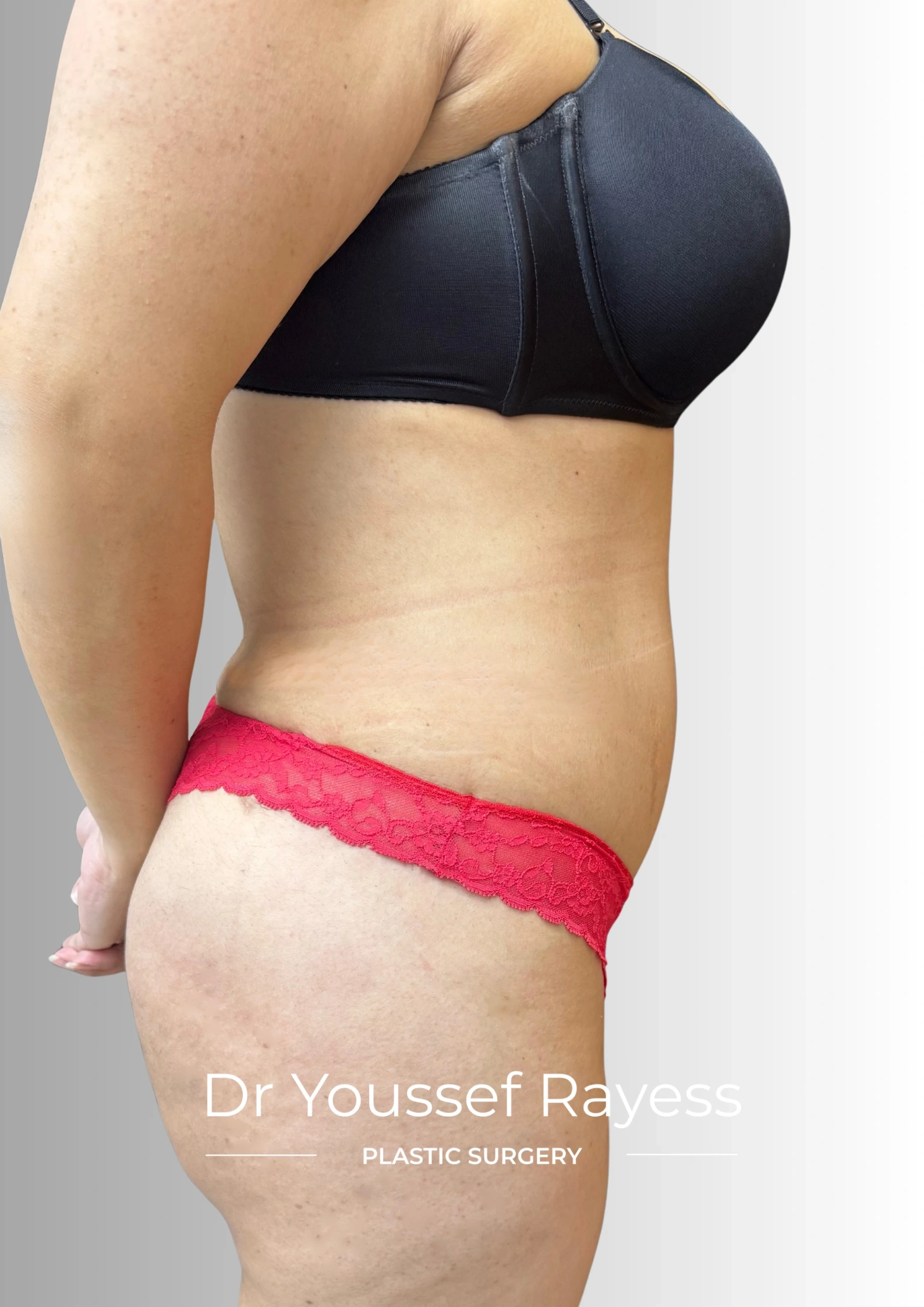 Side view after body lift and Brazilian butt lift surgery result by Dr Youssef Rayess in Beirut showing natural body rejuvenation and harmony