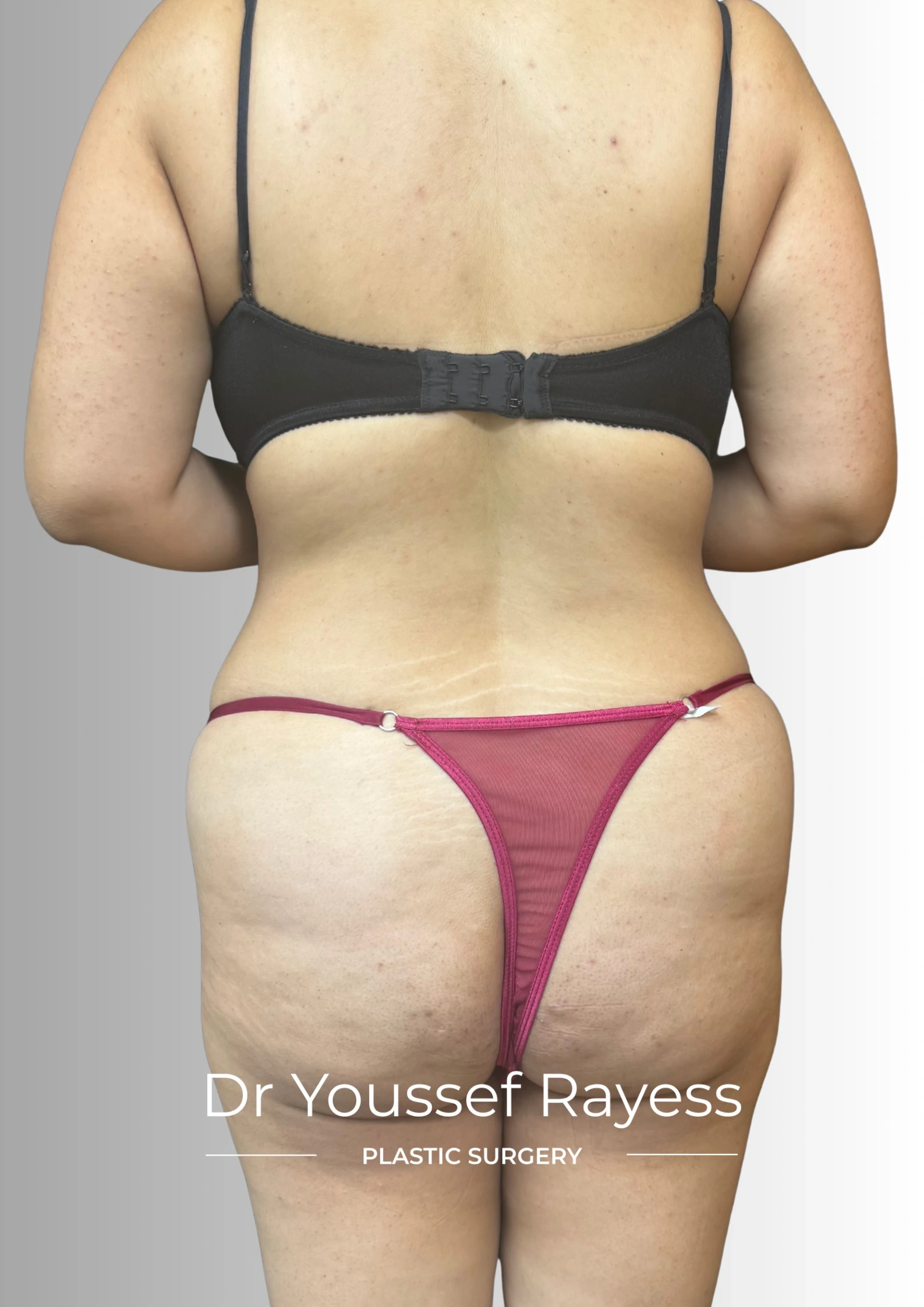 Back view before body lift and Brazilian butt lift surgery by Dr Youssef Rayess in Beirut