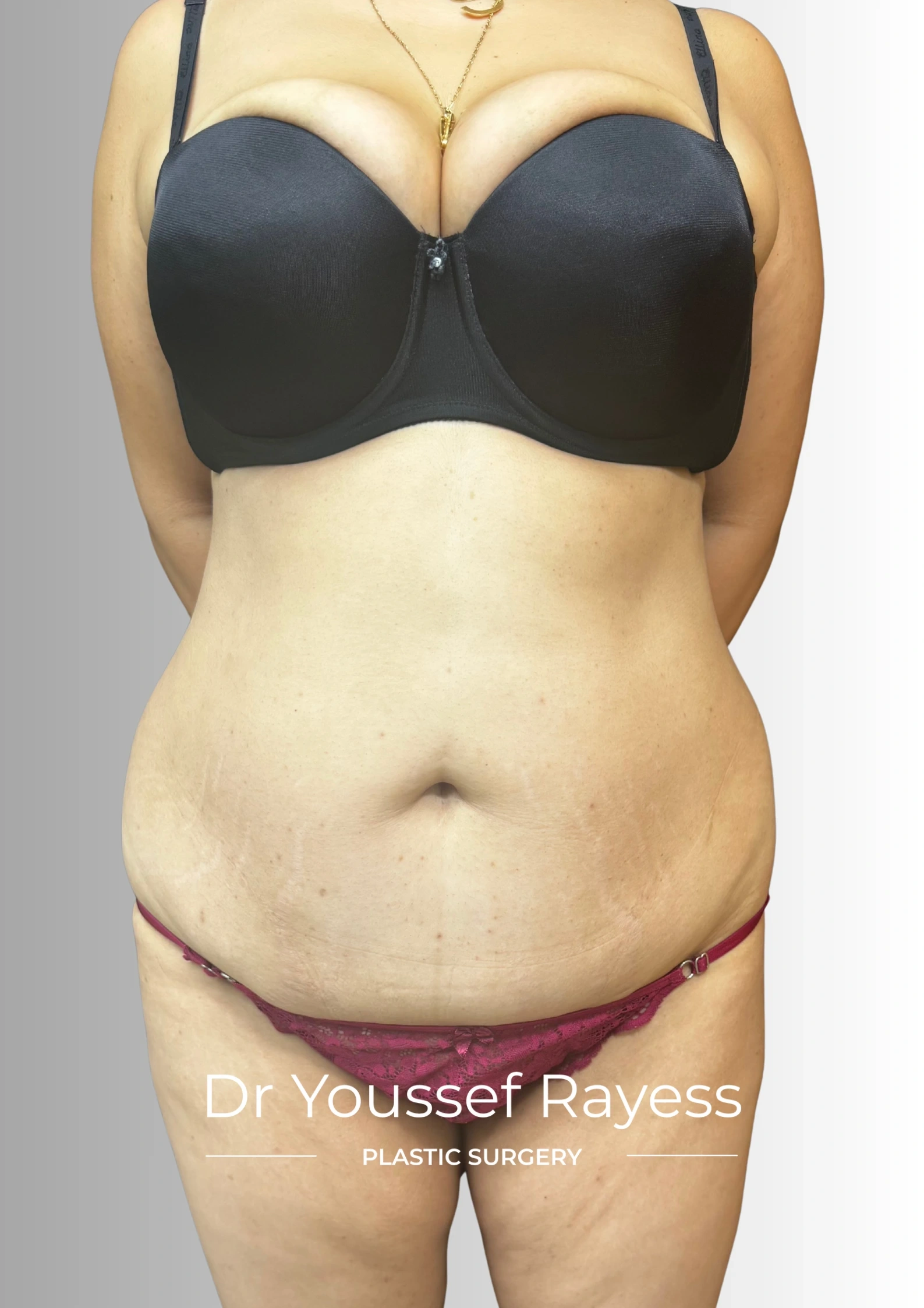 Front view before body lift and Brazilian butt lift surgery by Dr Youssef Rayess in Beirut