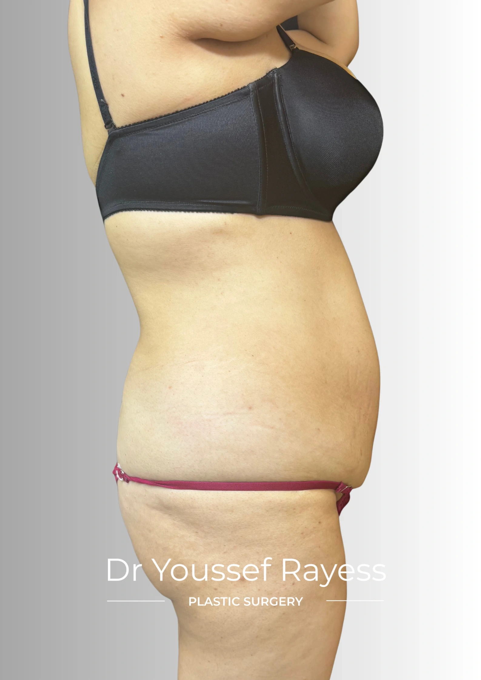 Side view before body lift and Brazilian butt lift surgery by Dr Youssef Rayess in Beirut