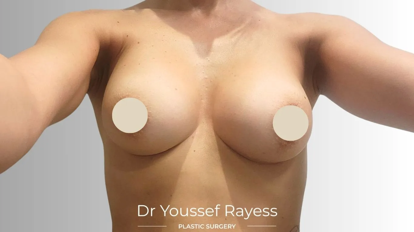 Front view after breast augmentation surgery result by Dr Youssef Rayess in Beirut showing natural breast rejuvenation and harmony