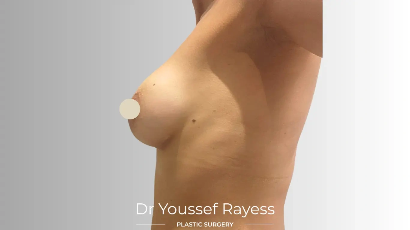 Left side view after breast augmentation surgery result by Dr Youssef Rayess in Beirut showing natural breast rejuvenation and harmony