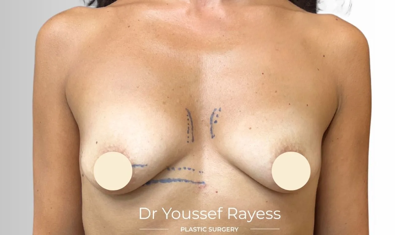 Front view before breast augmentation surgery by Dr Youssef Rayess in Beirut