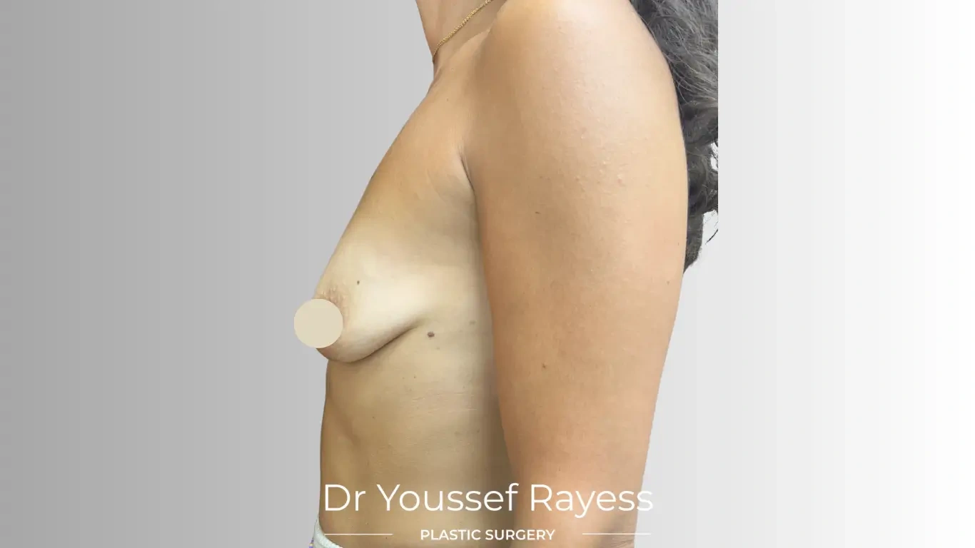Left side view before breast augmentation surgery by Dr Youssef Rayess in Beirut