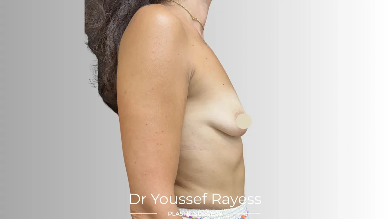 Right side view before breast augmentation surgery by Dr Youssef Rayess in Beirut