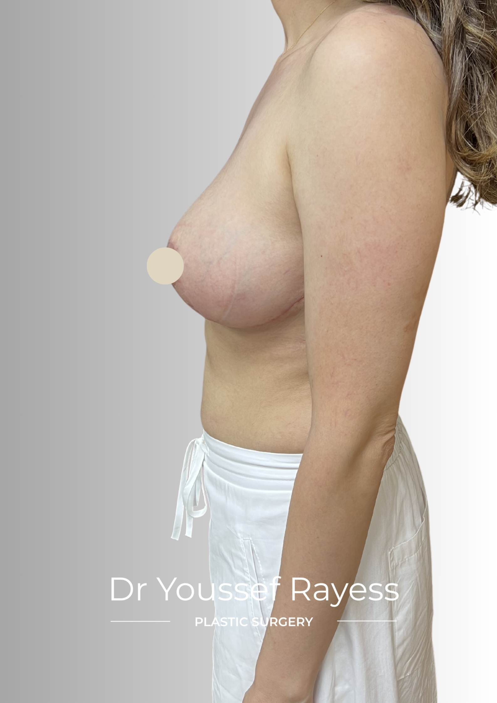 Left side view after breast lift surgery result by Dr Youssef Rayess in Beirut showing natural breast rejuvenation and harmony