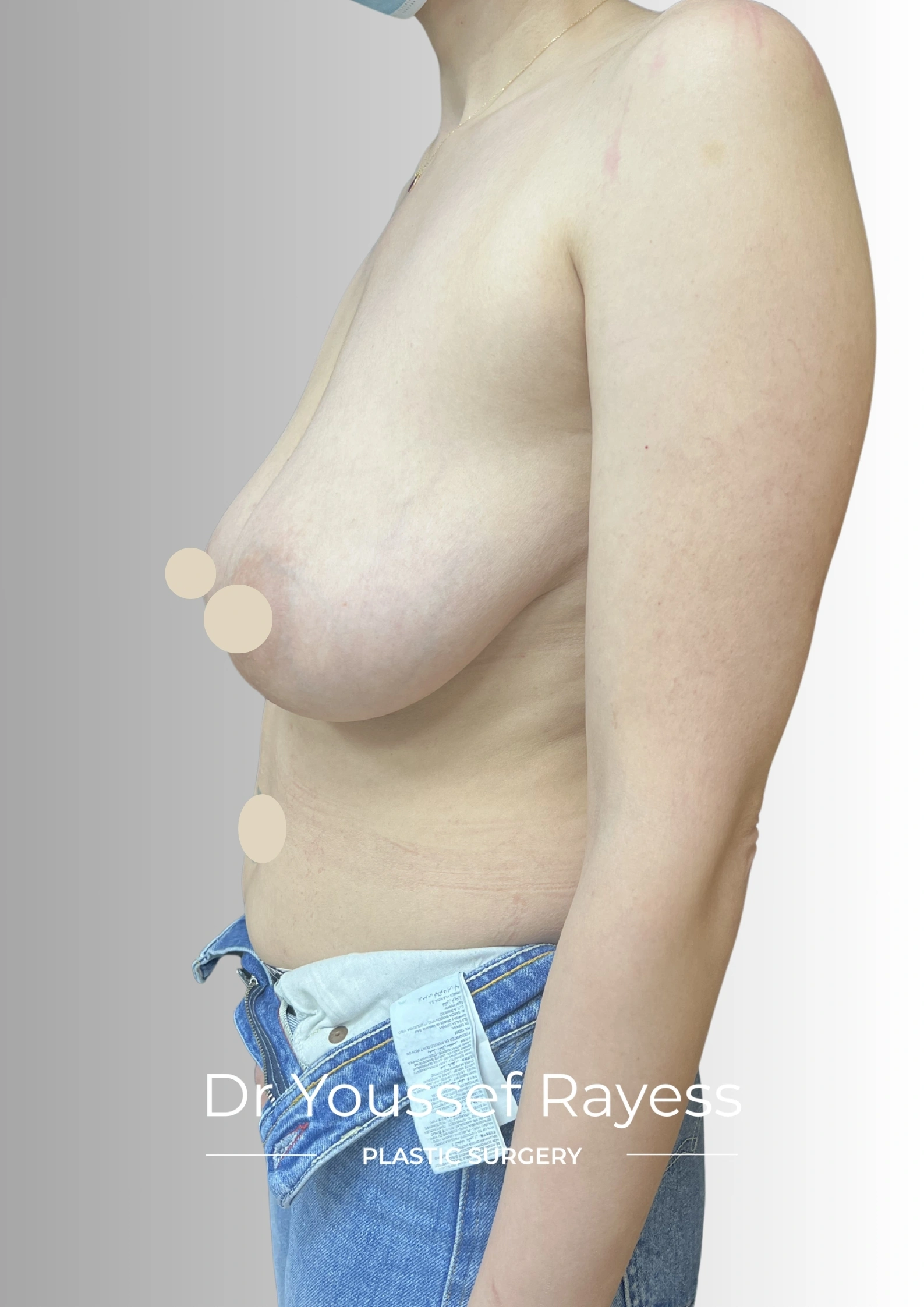 Left side view before breast lift surgery by Dr Youssef Rayess in Beirut