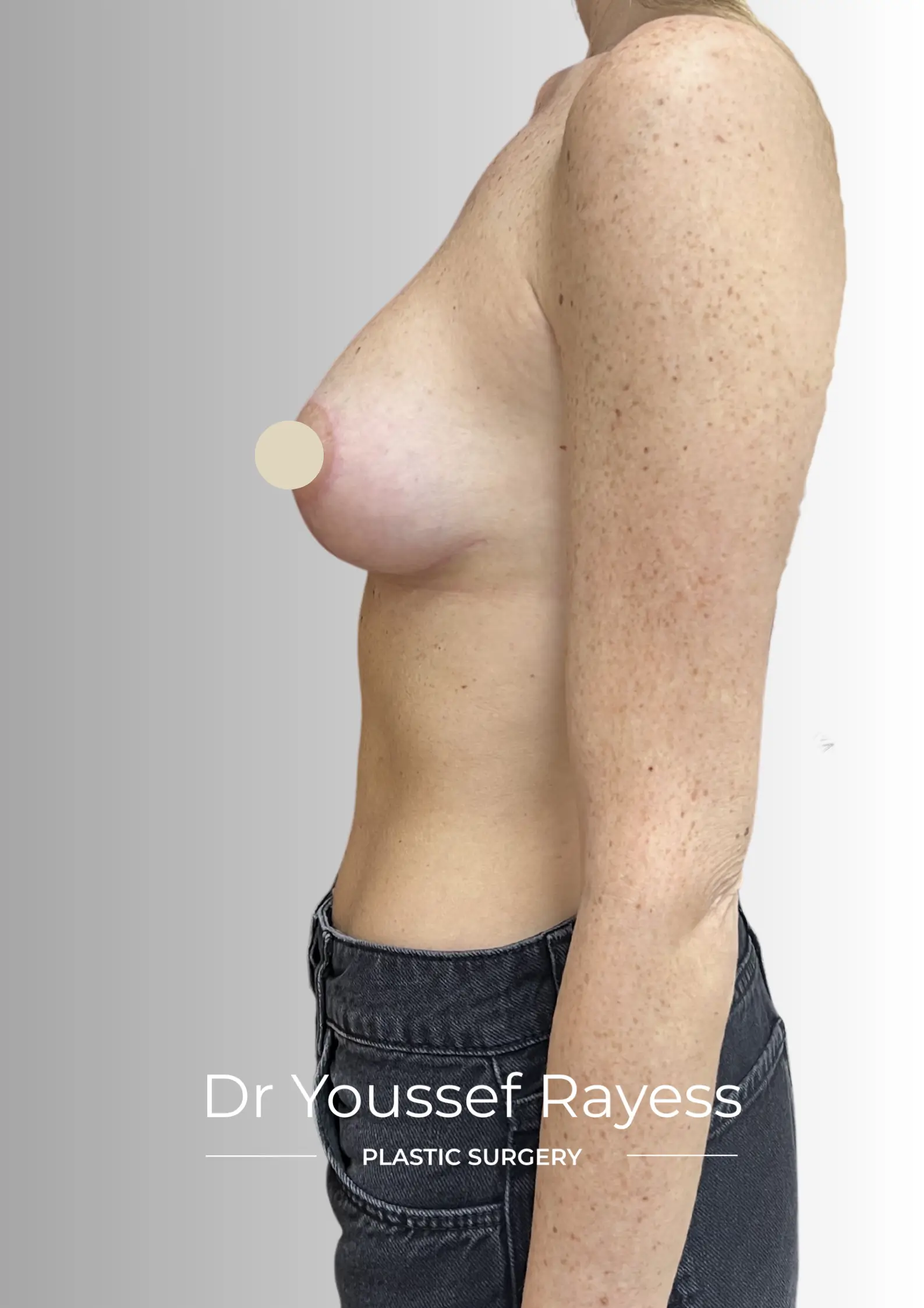Left side view after breast augmentation mastopexy surgery result by Dr Youssef Rayess in Beirut showing natural breast rejuvenation and harmony
