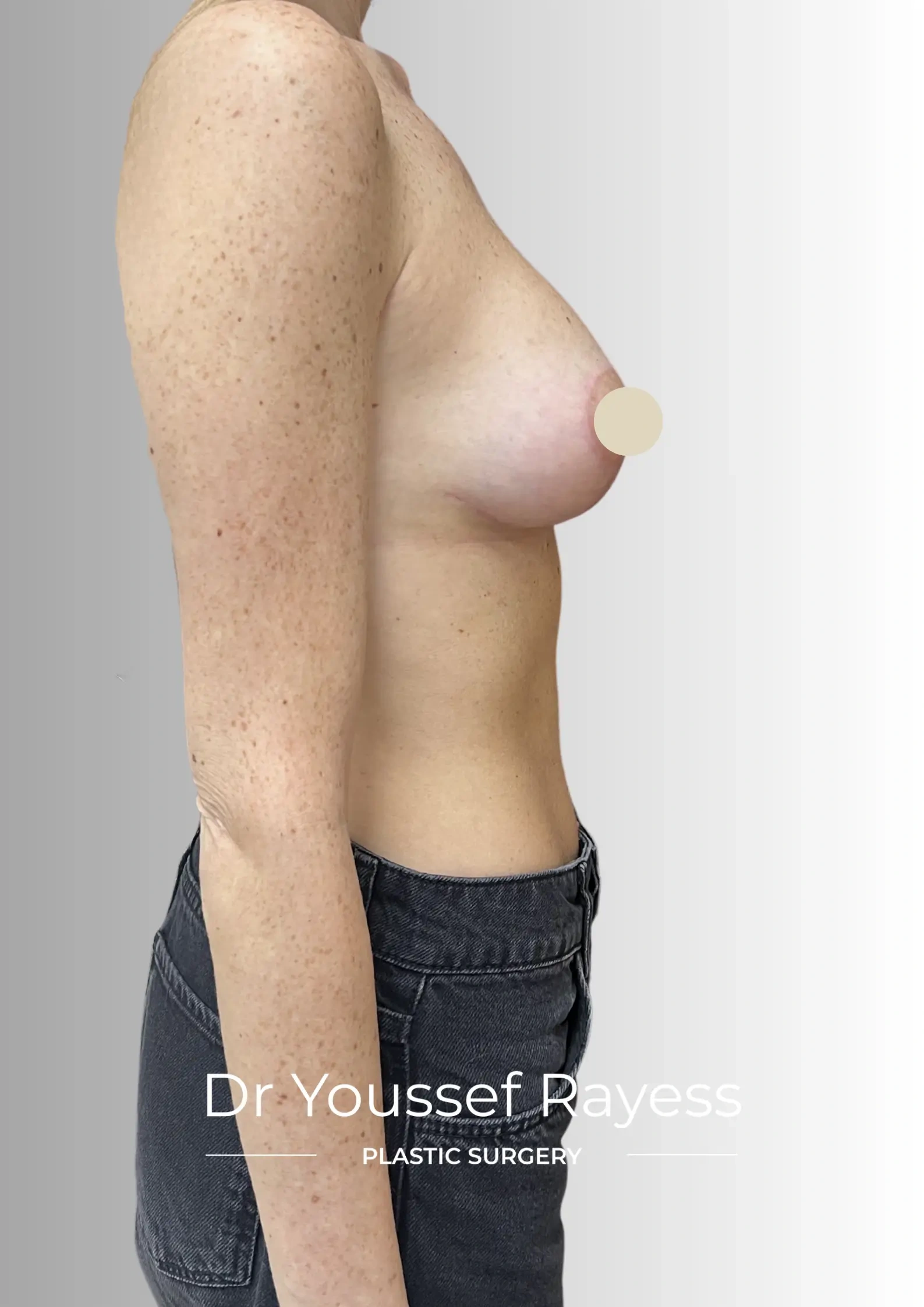 Right side view after breast augmentation mastopexy surgery result by Dr Youssef Rayess in Beirut showing natural breast rejuvenation and harmony