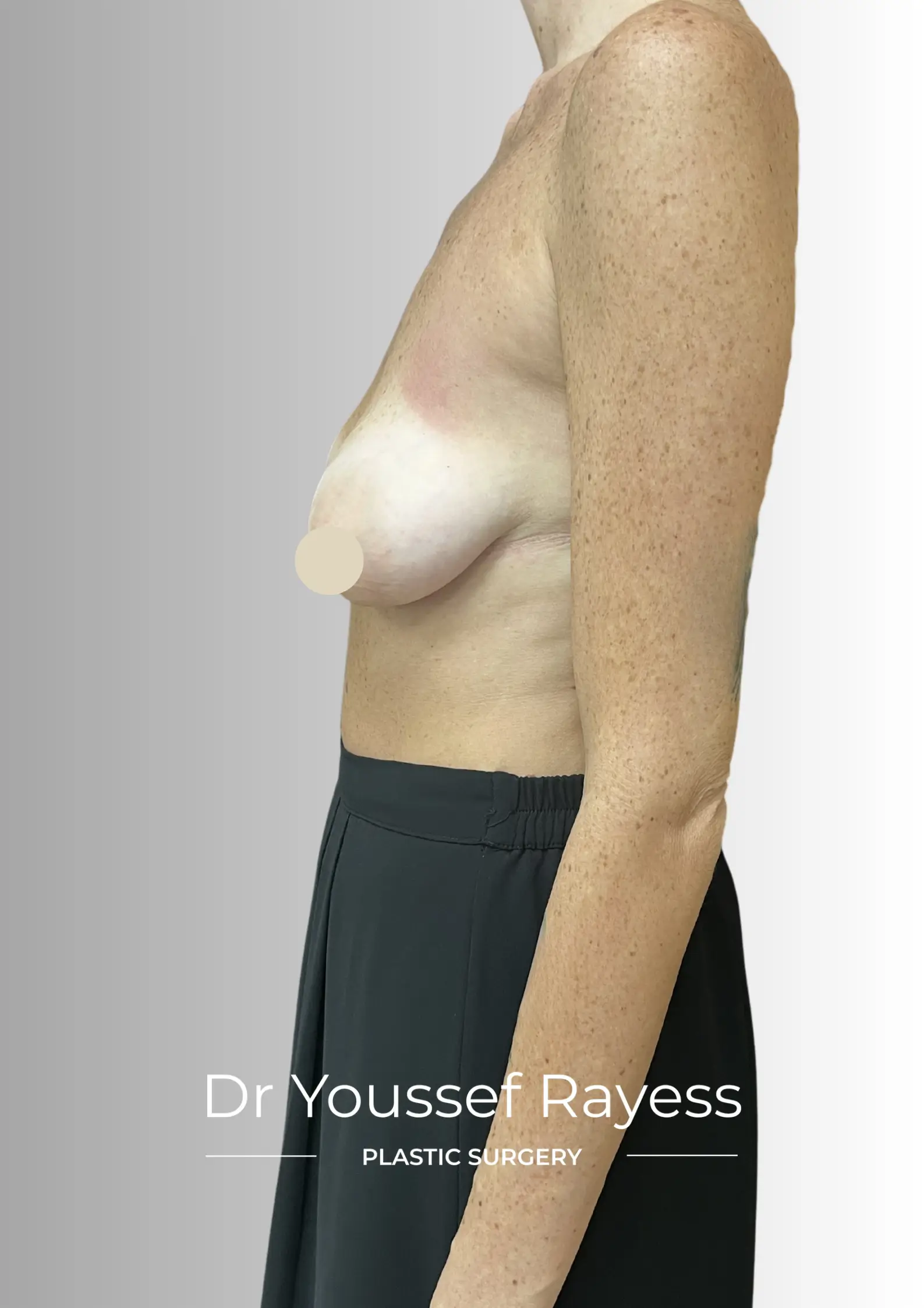 Left side view before breast augmentation mastopexy surgery by Dr Youssef Rayess in Beirut