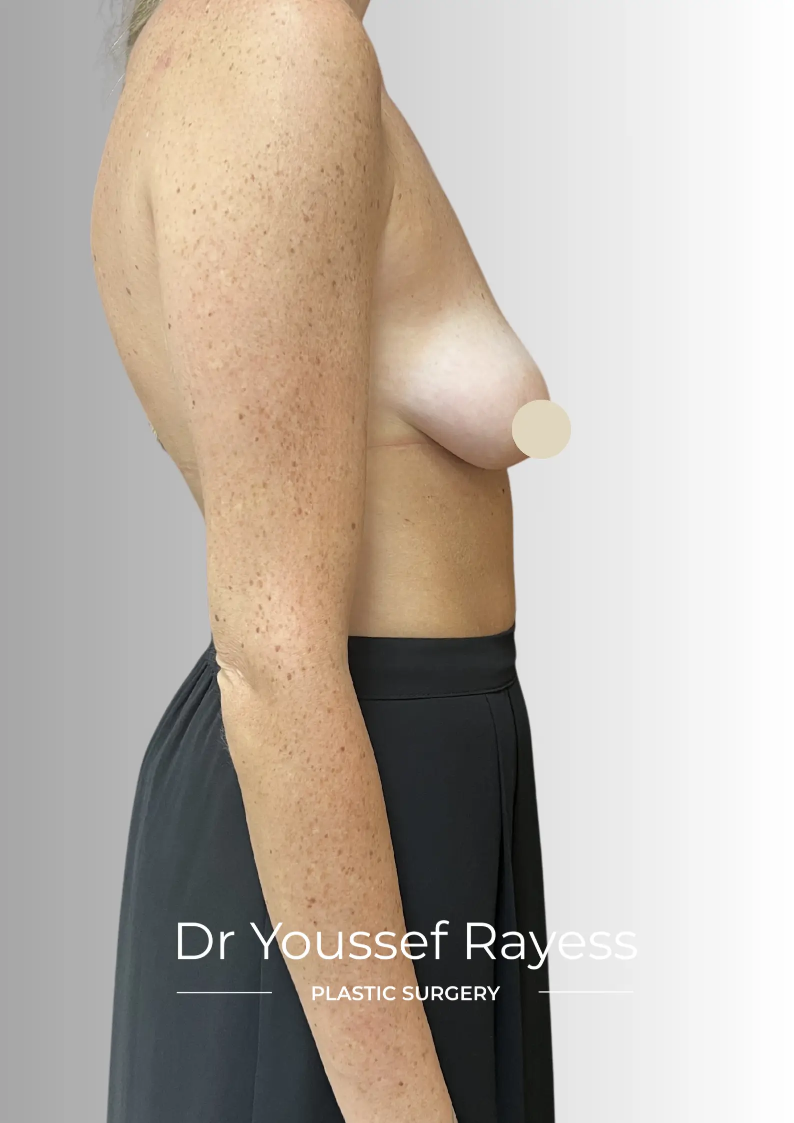 Right side view before breast augmentation mastopexy surgery by Dr Youssef Rayess in Beirut