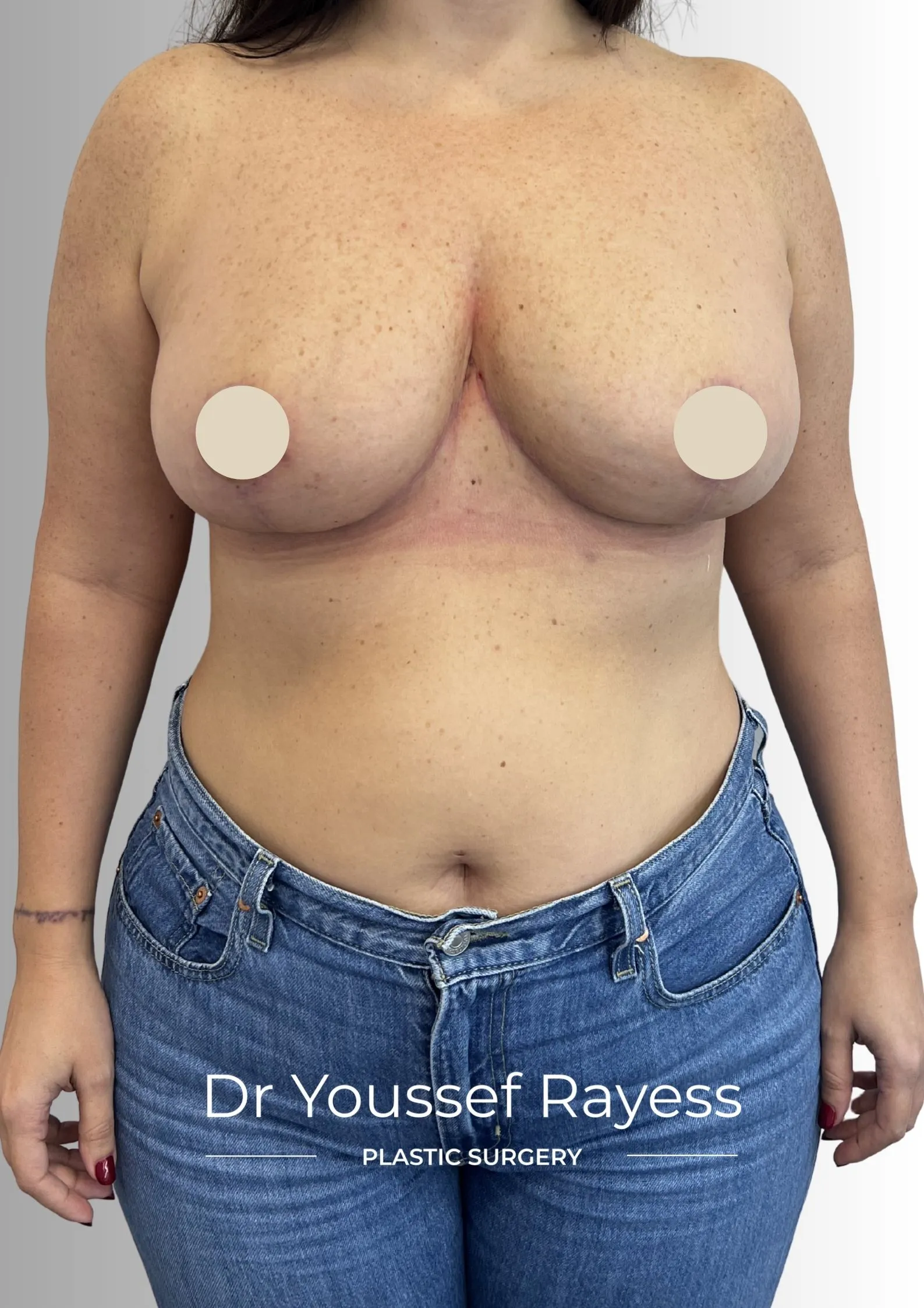 Front view after breast reduction surgery result by Dr Youssef Rayess in Beirut showing natural breast rejuvenation and harmony