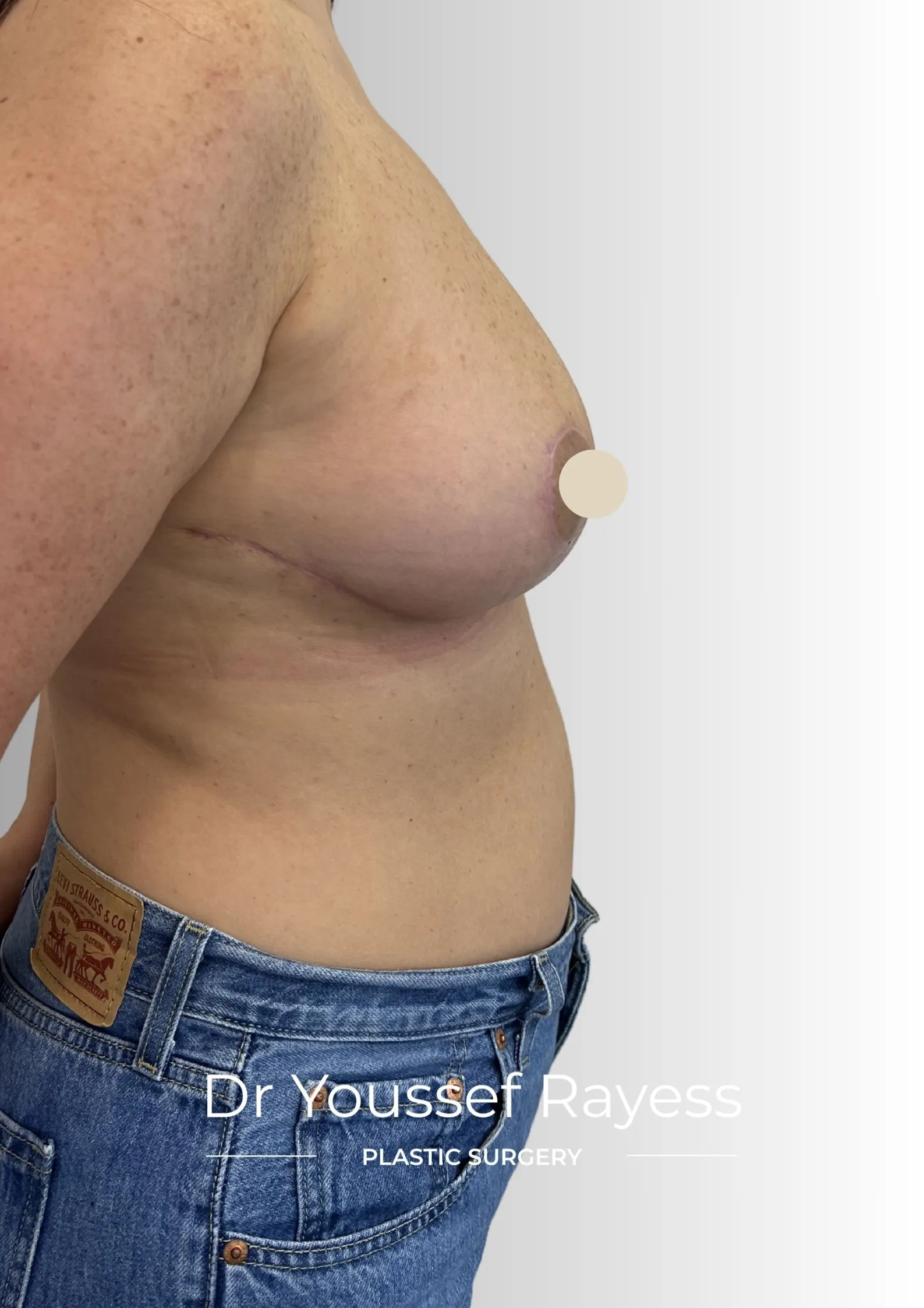 Right side view after breast reduction surgery result by Dr Youssef Rayess in Beirut showing natural breast rejuvenation and harmony