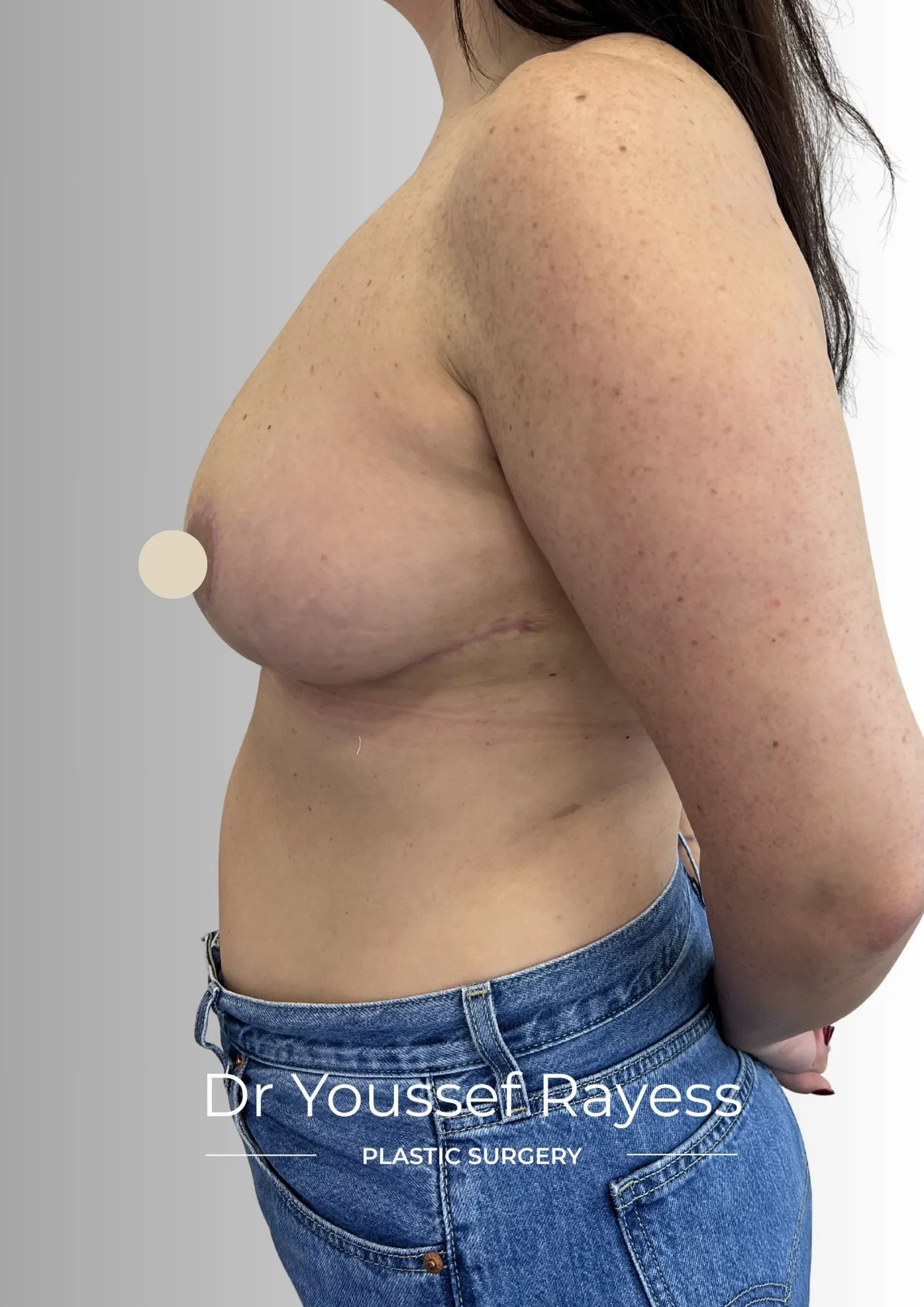 Left side view after breast reduction surgery result by Dr Youssef Rayess in Beirut showing natural breast rejuvenation and harmony