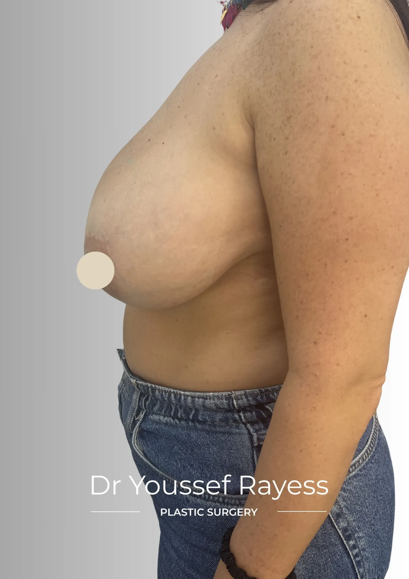 Left side view before breast reduction surgery by Dr Youssef Rayess in Beirut