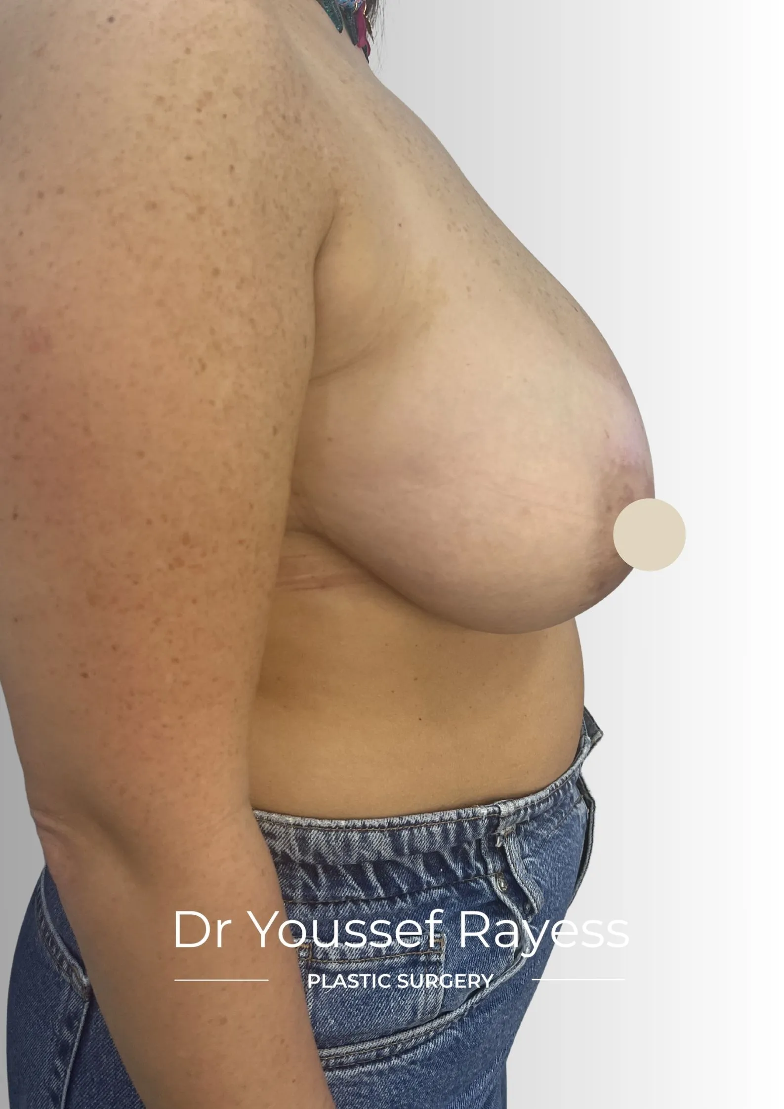 Right side view before breast reduction surgery by Dr Youssef Rayess in Beirut
