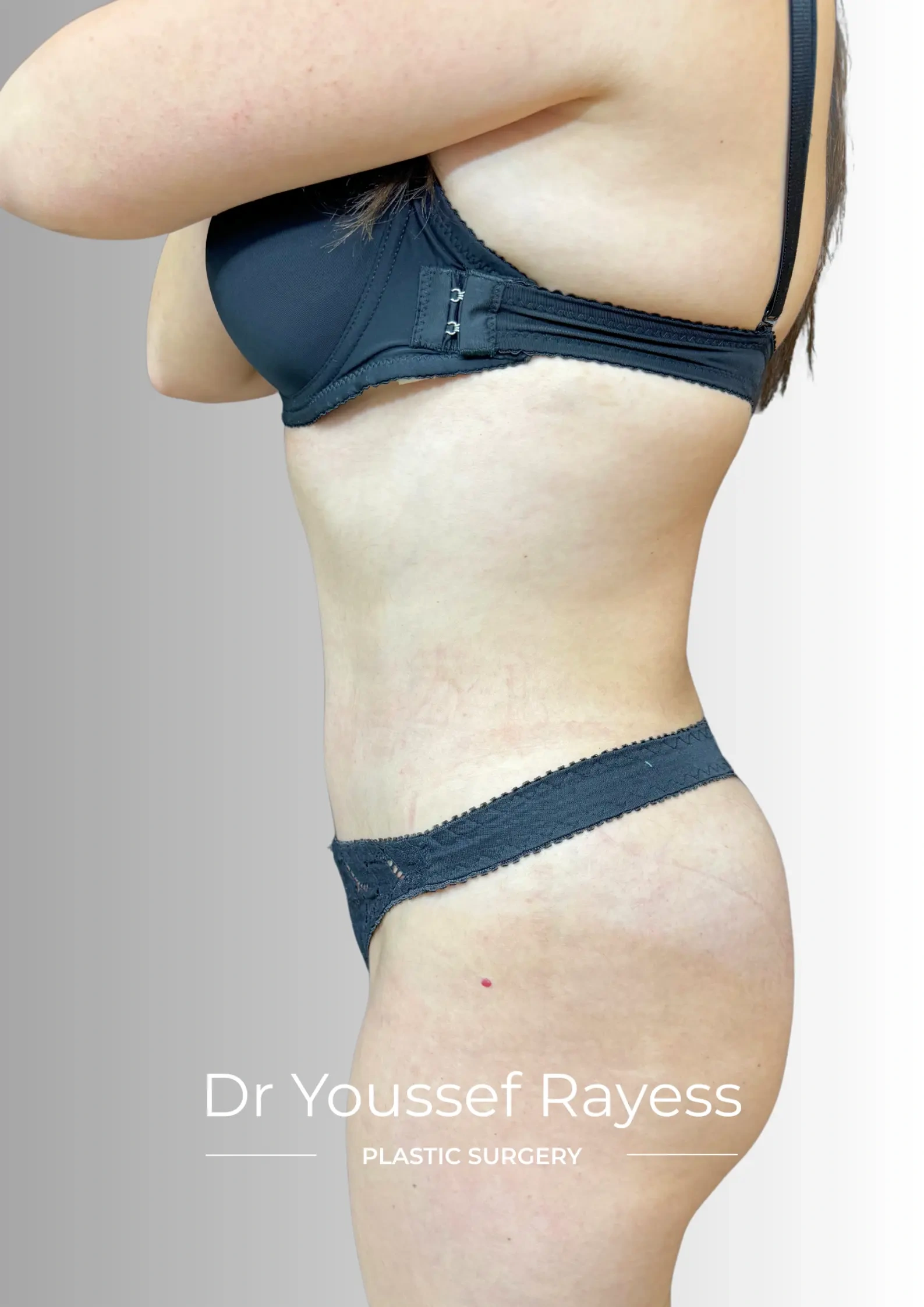 Side view after tummy tuck and HD liposuction surgery result by Dr Youssef Rayess in Beirut showing natural body rejuvenation and harmony