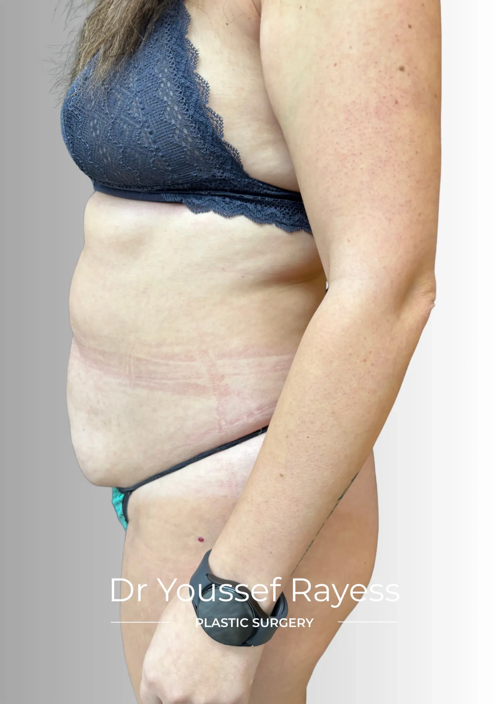Side view before tummy tuck and HD liposuction surgery result by Dr Youssef Rayess in Beirut showing natural body rejuvenation and harmony