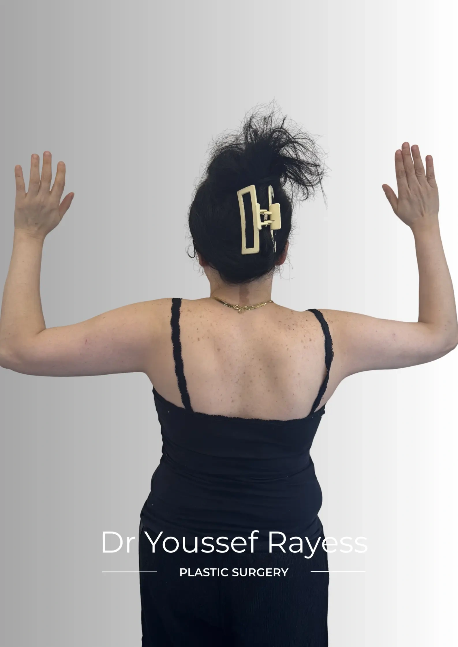 Back view after arm liposuction and quantum radiofrequency surgery result by Dr Youssef Rayess in Beirut and Dubai showing natural arm rejuvenation and harmony