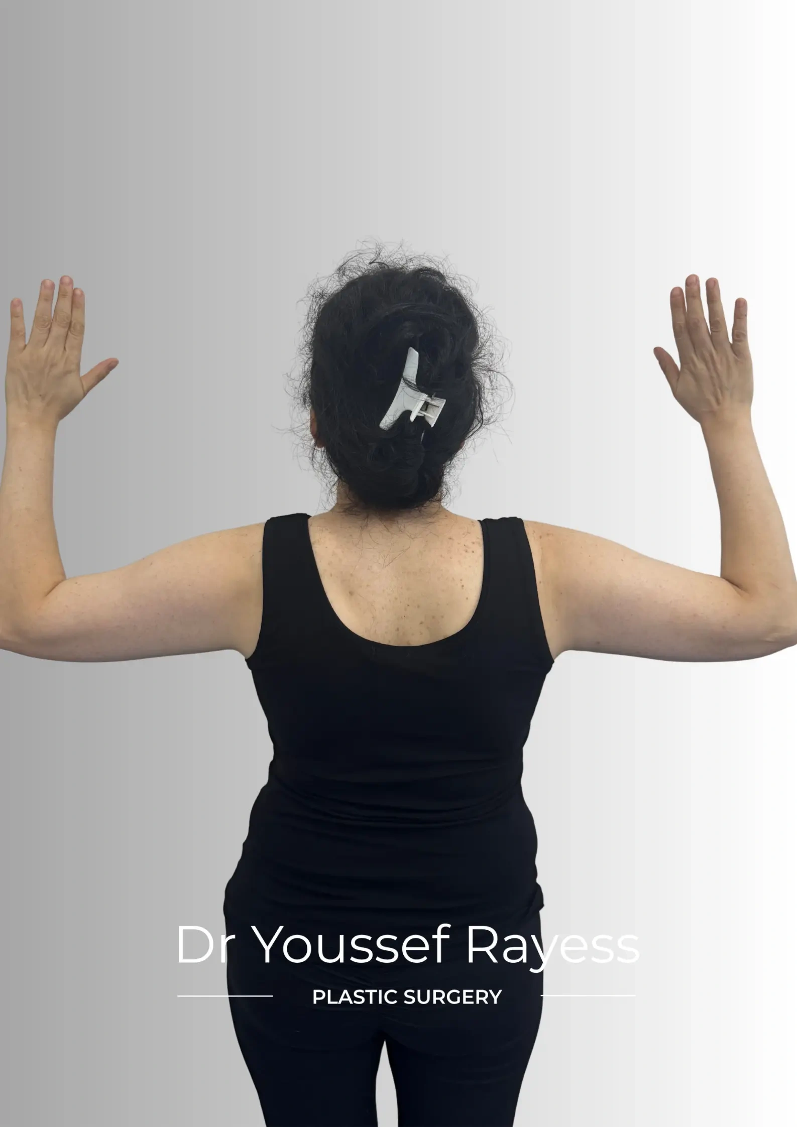 Back view before arm liposuction and quantum radiofrequency surgery  by Dr Youssef Rayess