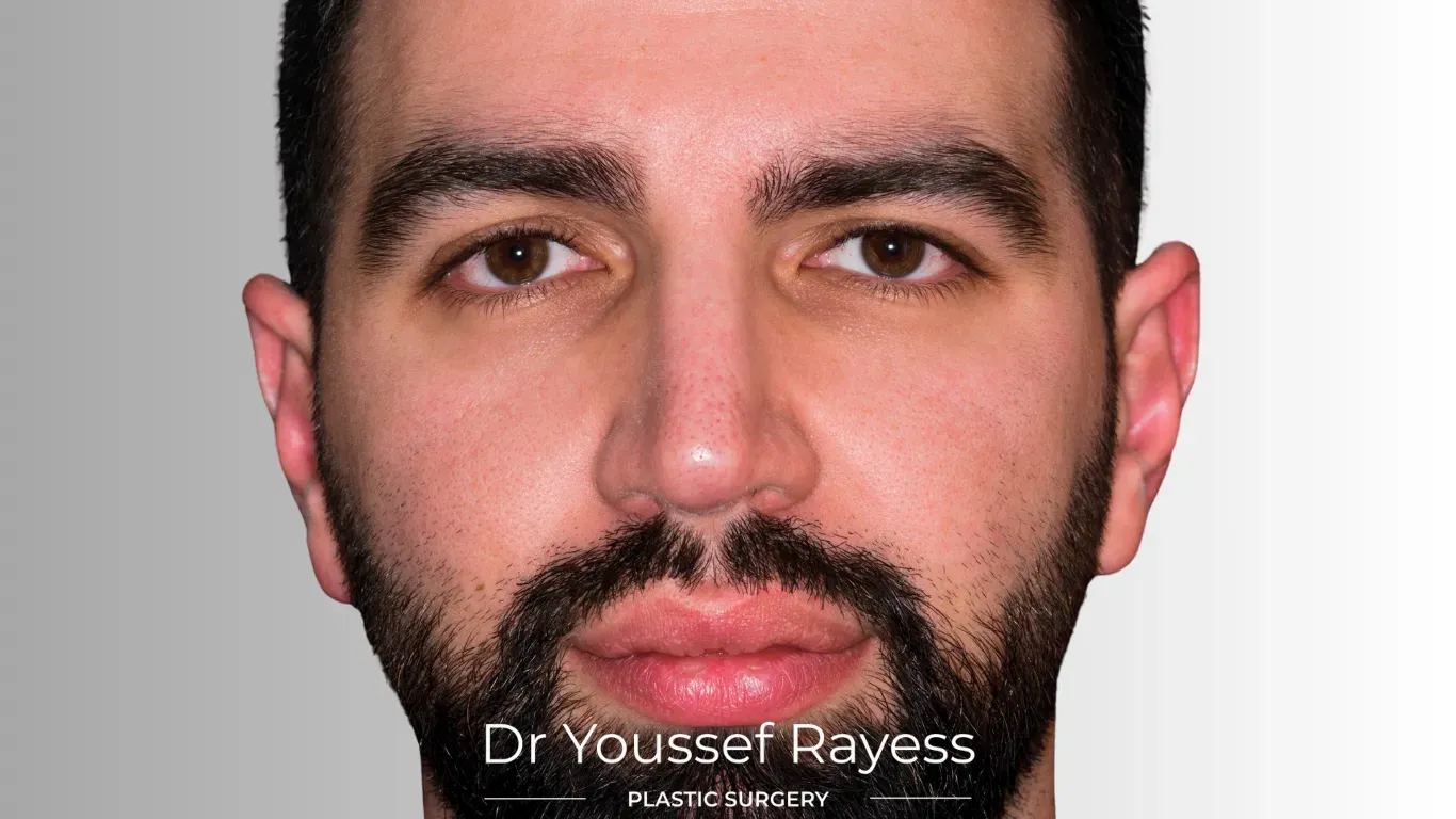 Front view after structural rhinoplasty result by Dr Youssef Rayess in Beirut and Dubai showing natural nasal refinement and facial harmony
