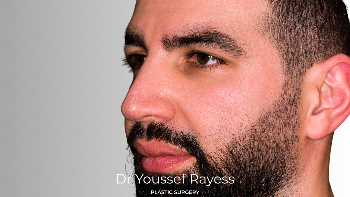 3/4 left side view after structural rhinoplasty result by Dr Youssef Rayess in Beirut and Dubai showing natural nasal refinement and facial harmony