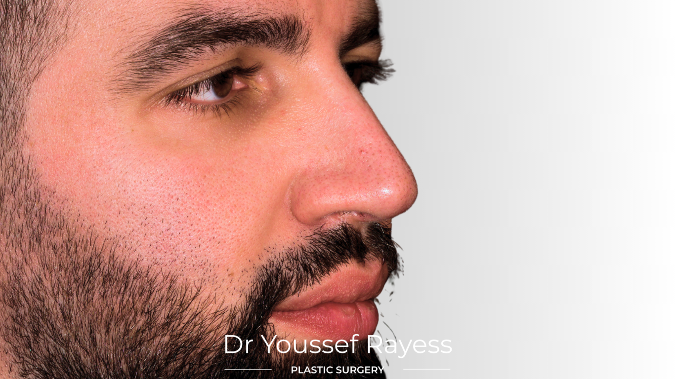 3/4 right side view after structural rhinoplasty result by Dr Youssef Rayess in Beirut and Dubai showing natural nasal refinement and facial harmony
