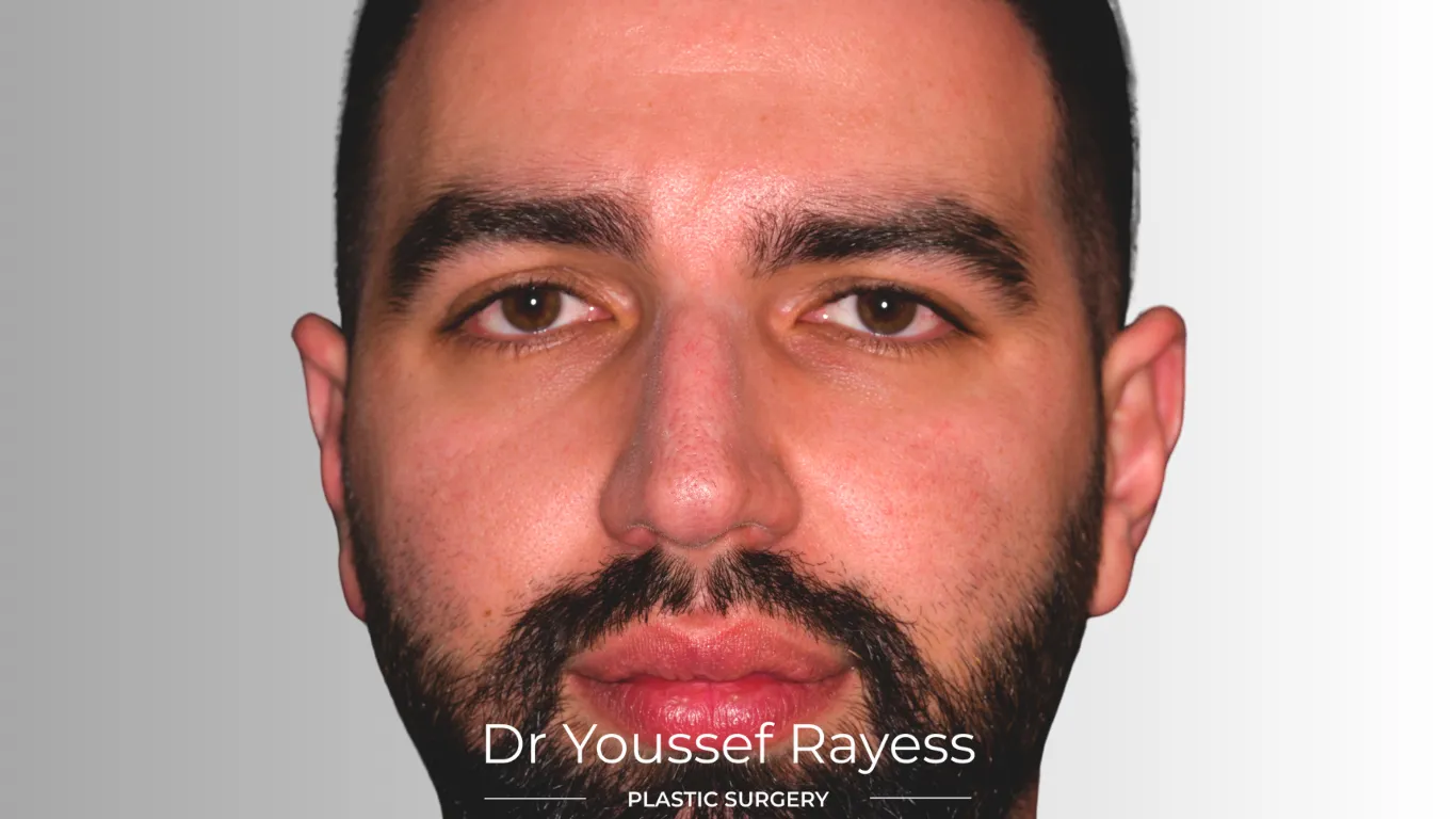Front view before structural rhinoplasty result by Dr Youssef Rayess in Beirut and Dubai showing natural nasal refinement and facial harmony