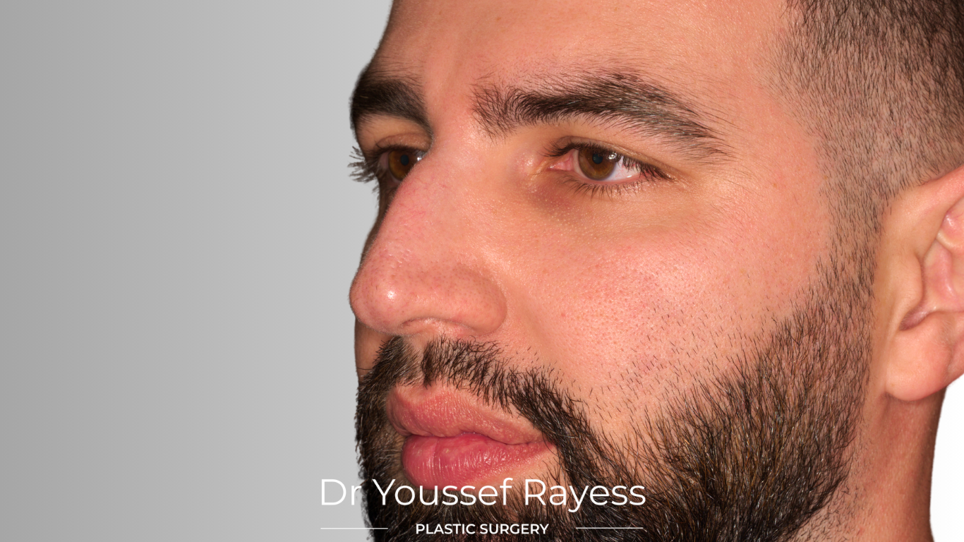 3/4 left side view before structural rhinoplasty result by Dr Youssef Rayess in Beirut and Dubai showing natural nasal refinement and facial harmony