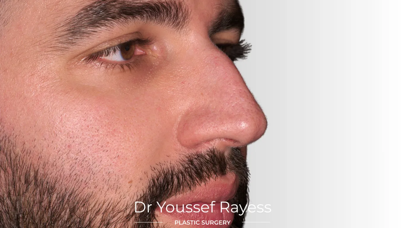 3/4 right view before structural rhinoplasty result by Dr Youssef Rayess in Beirut and Dubai showing natural nasal refinement and facial harmony