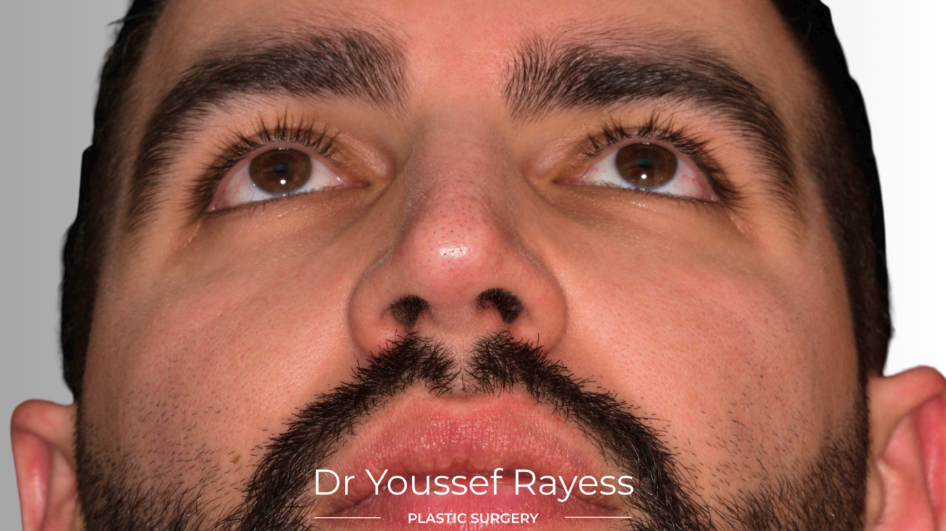 Basal view after structural rhinoplasty result by Dr Youssef Rayess in Beirut and Dubai showing natural nasal refinement and facial harmony