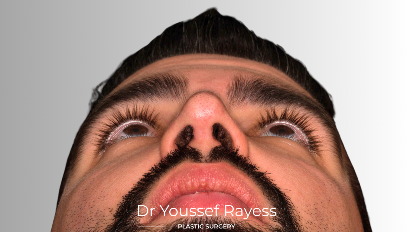 Full basal view after structural rhinoplasty result by Dr Youssef Rayess in Beirut and Dubai showing natural nasal refinement and facial harmony