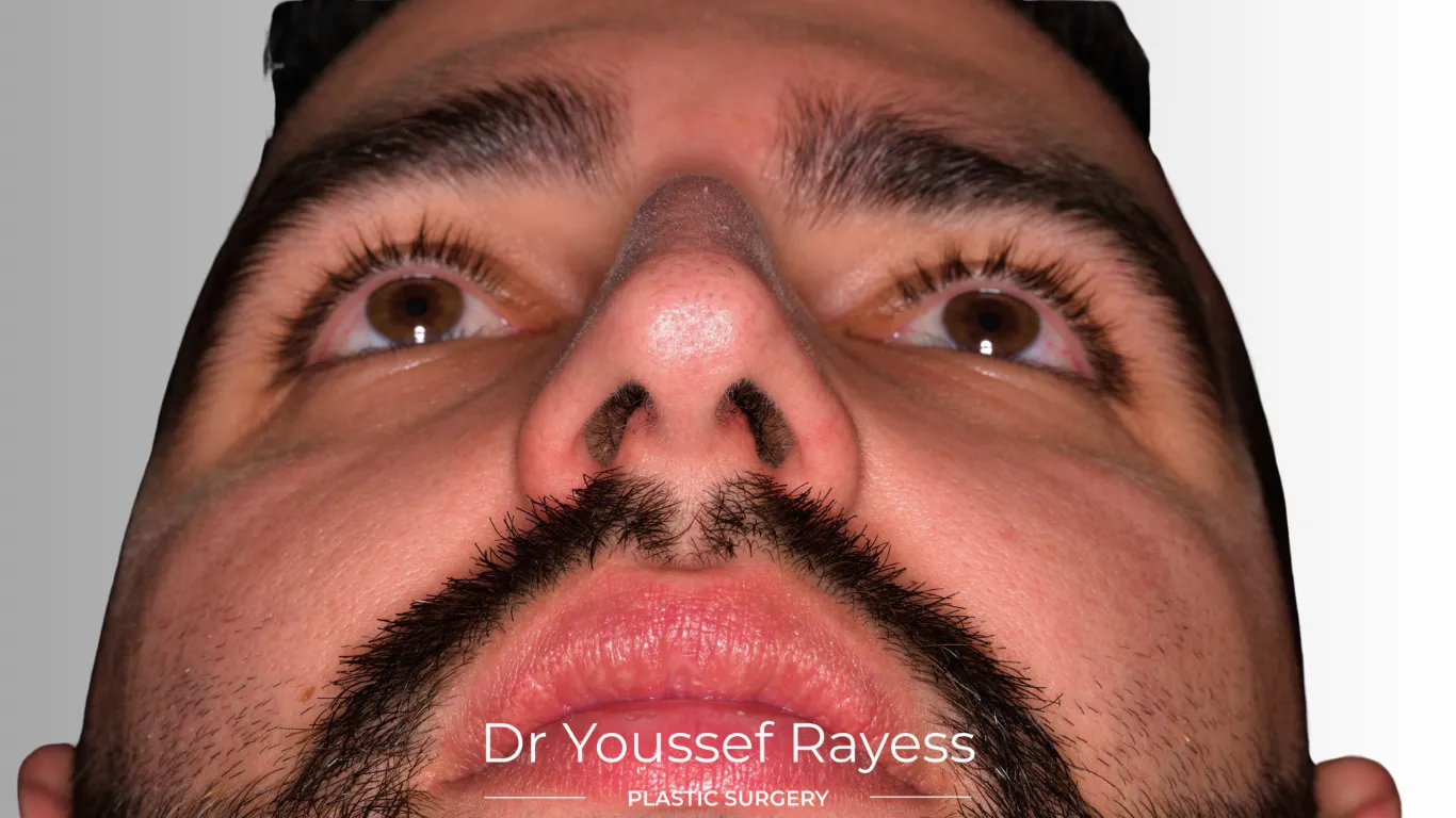 Basal view before structural rhinoplasty result by Dr Youssef Rayess in Beirut and Dubai showing natural nasal refinement and facial harmony