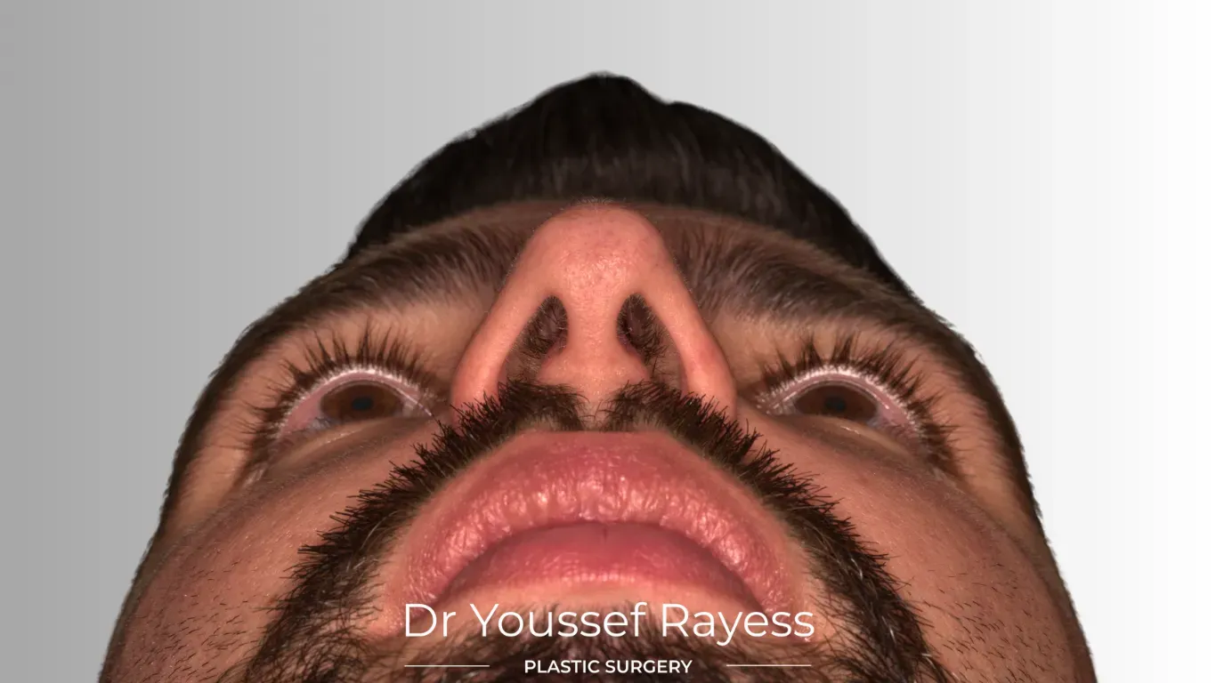 Full basal view before structural rhinoplasty result by Dr Youssef Rayess in Beirut and Dubai showing natural nasal refinement and facial harmony
