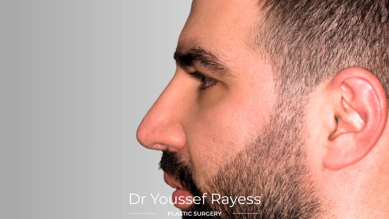 Left side  view after structural rhinoplasty result by Dr Youssef Rayess in Beirut and Dubai showing natural nasal refinement and facial harmony