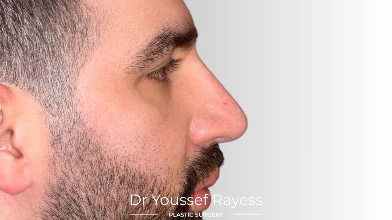 Right side view after structural rhinoplasty result by Dr Youssef Rayess in Beirut and Dubai showing natural nasal refinement and facial harmony