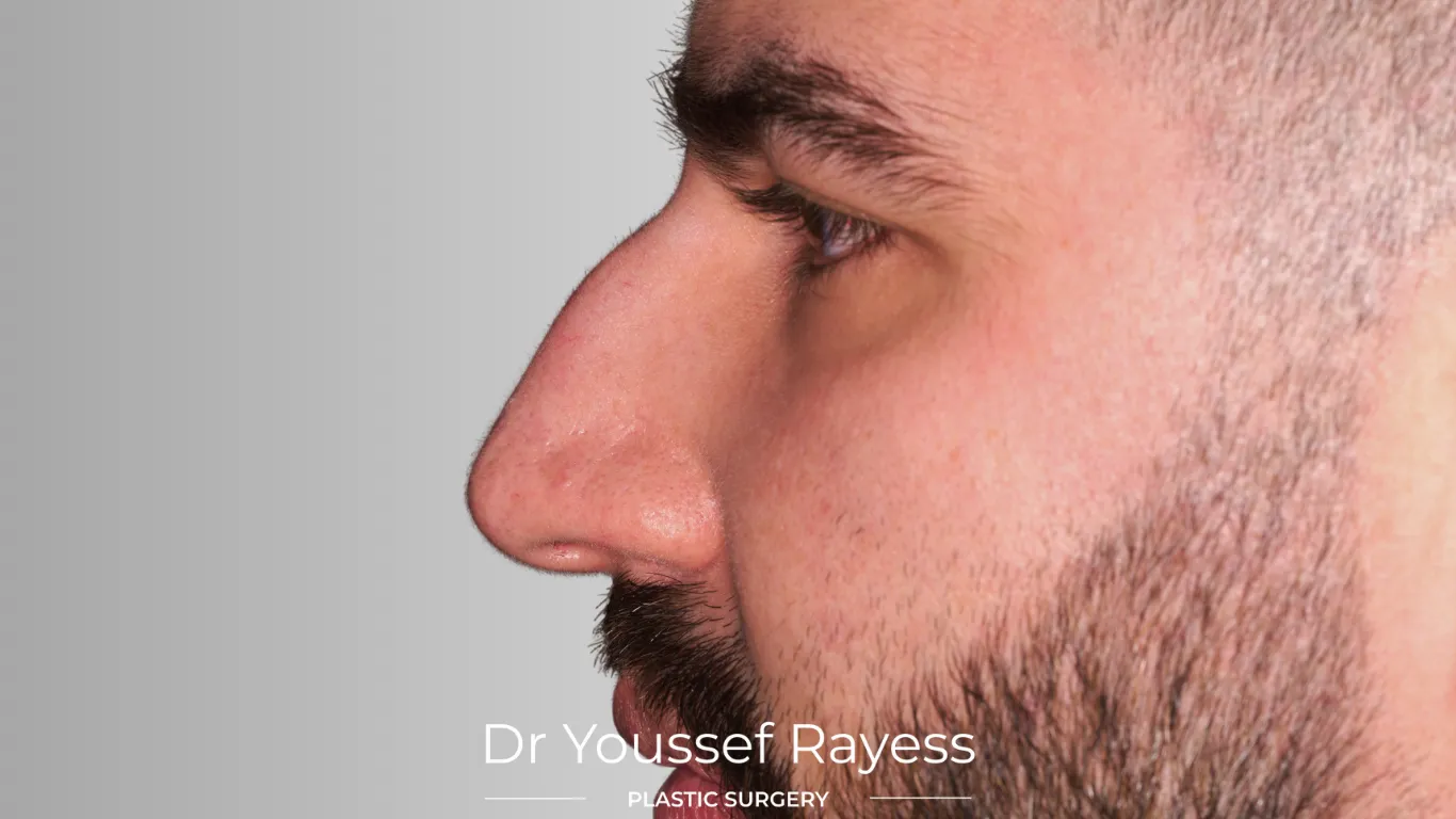 Left side view before structural rhinoplasty result by Dr Youssef Rayess in Beirut and Dubai showing natural nasal refinement and facial harmony