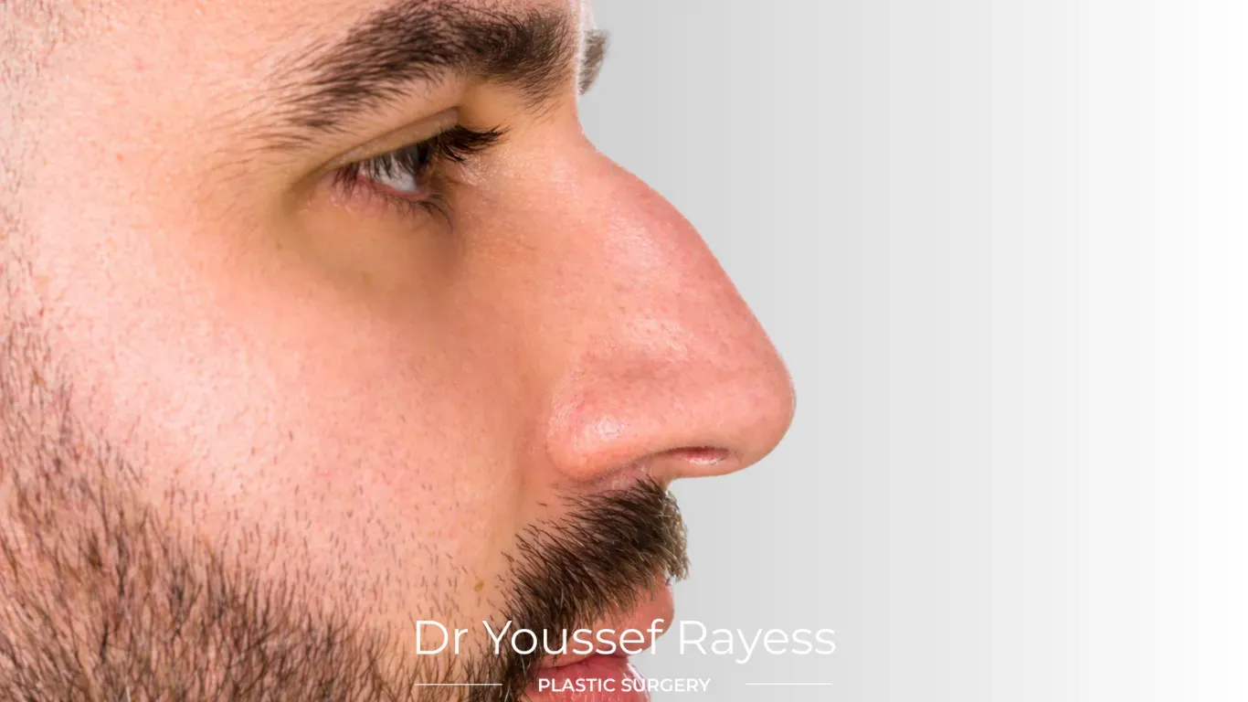 Right Side view before structural rhinoplasty result by Dr Youssef Rayess in Beirut and Dubai showing natural nasal refinement and facial harmony