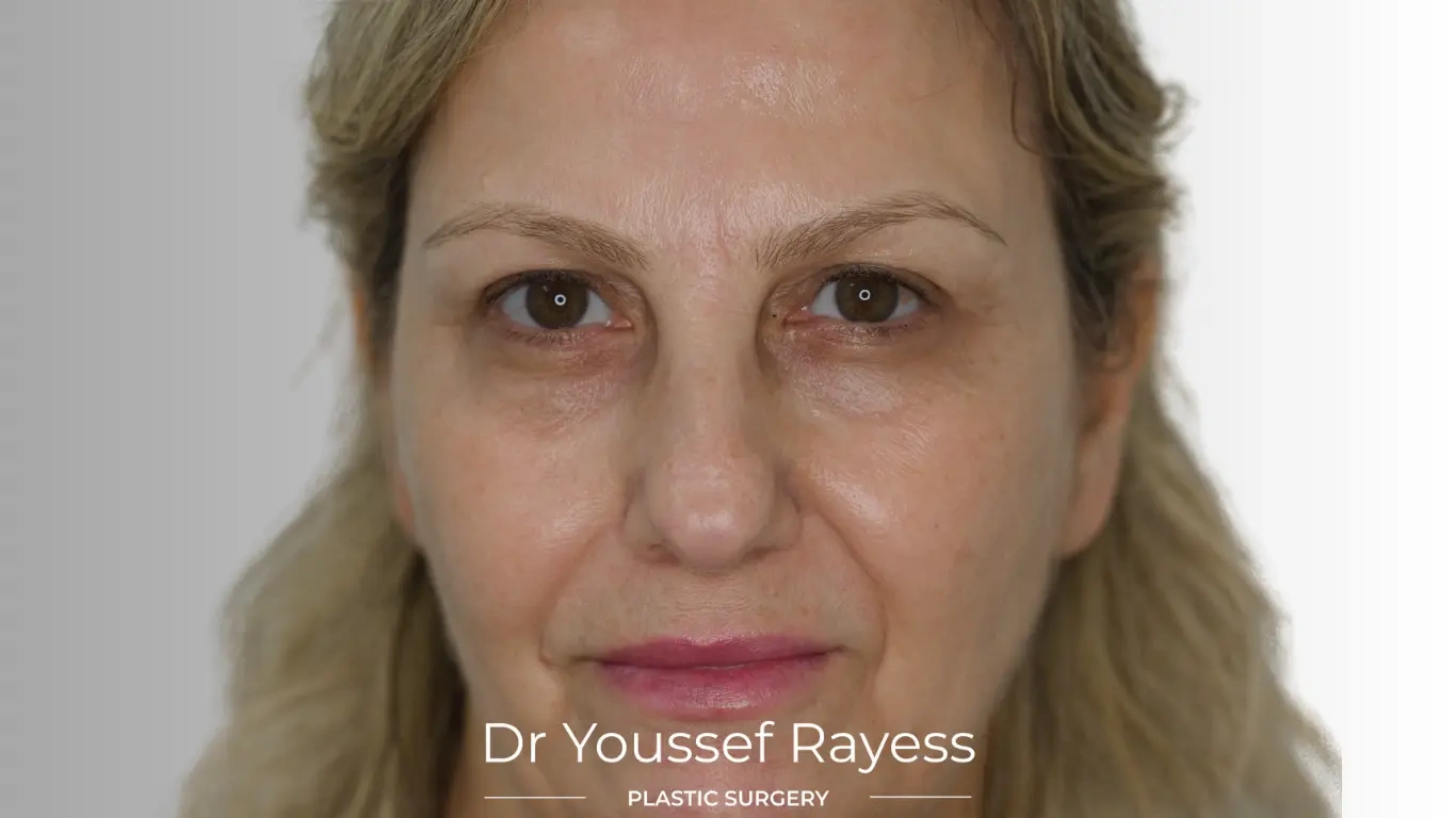 Front view after eyelid surgery result by Dr Youssef Rayess in Beirut and Dubai showing natural eyelid rejuvenation and facial harmony