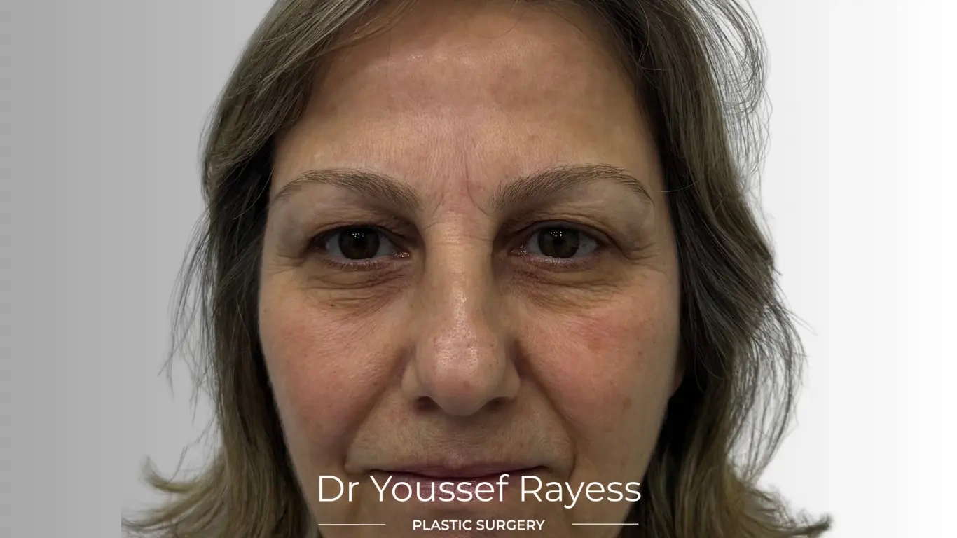Front view before eyelid surgery by Dr Youssef Rayess in Beirut and Dubai