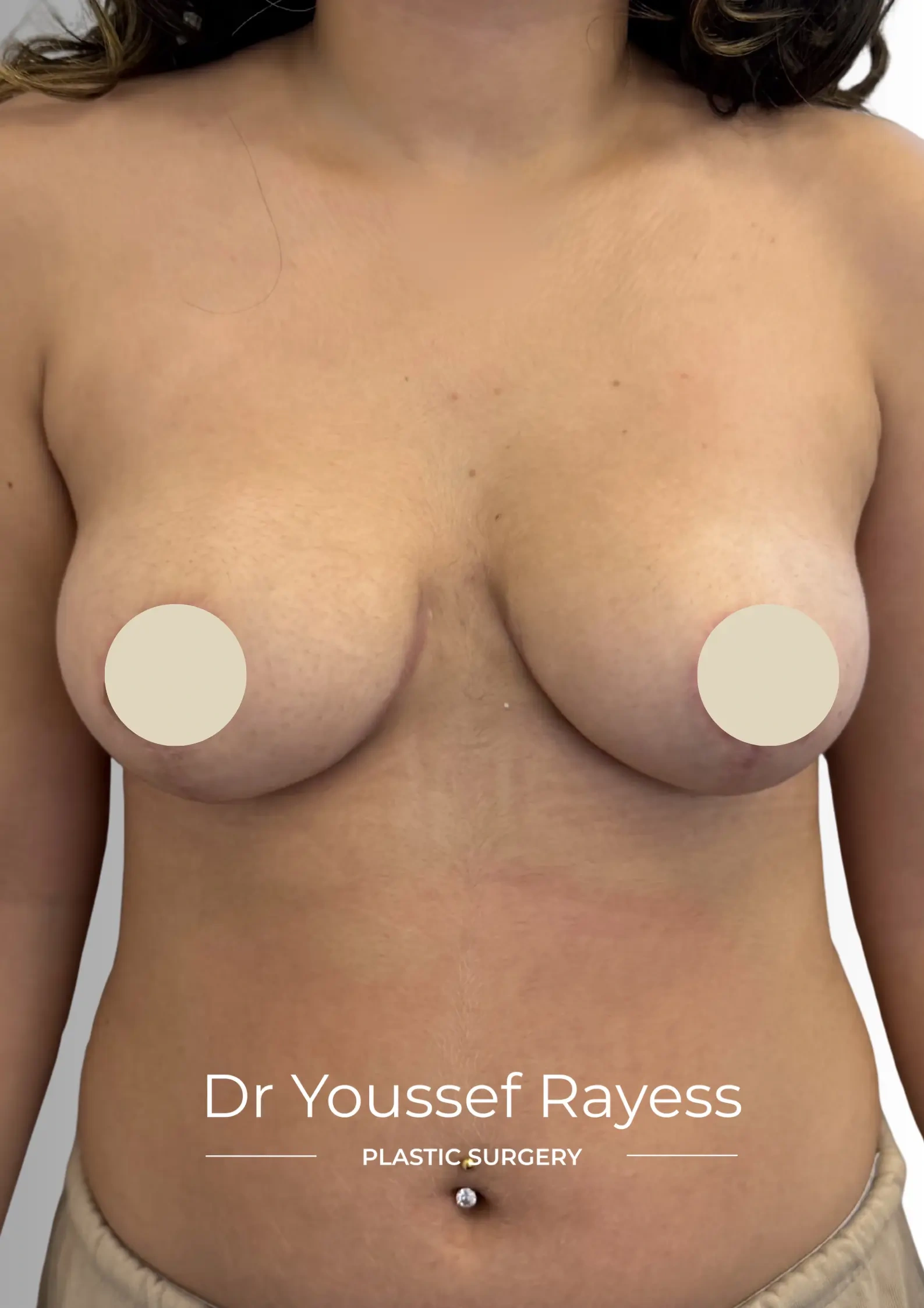 Front view after breast reduction surgery result by Dr Youssef Rayess in Beirut showing natural breast rejuvenation and harmony