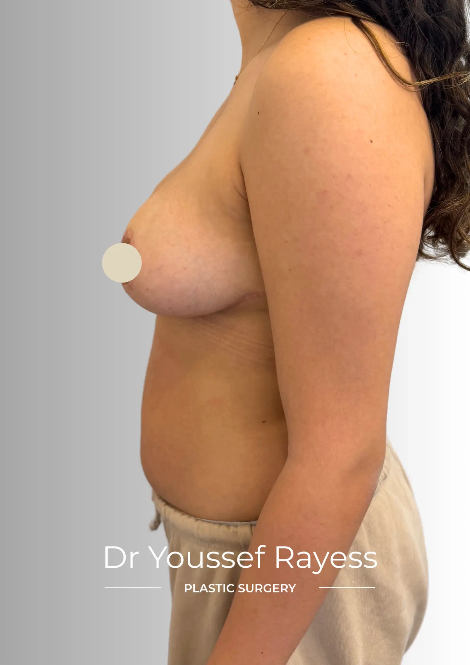 Left side view after breast reduction surgery result by Dr Youssef Rayess in Beirut showing natural breast rejuvenation and harmony
