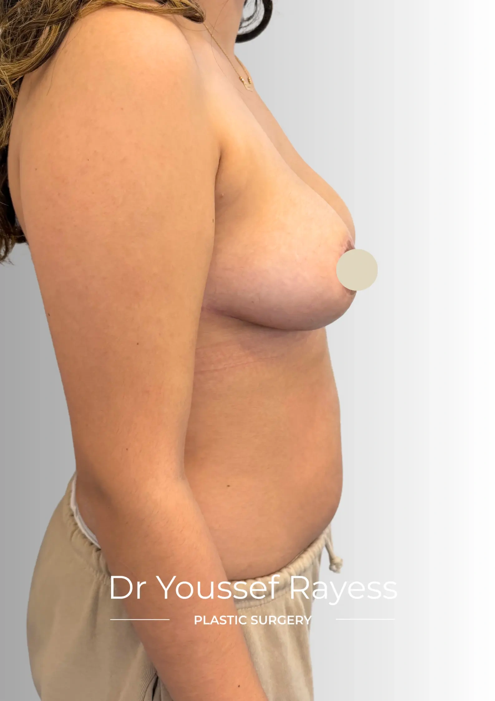 Right side view after breast reduction surgery result by Dr Youssef Rayess in Beirut showing natural breast rejuvenation and harmony